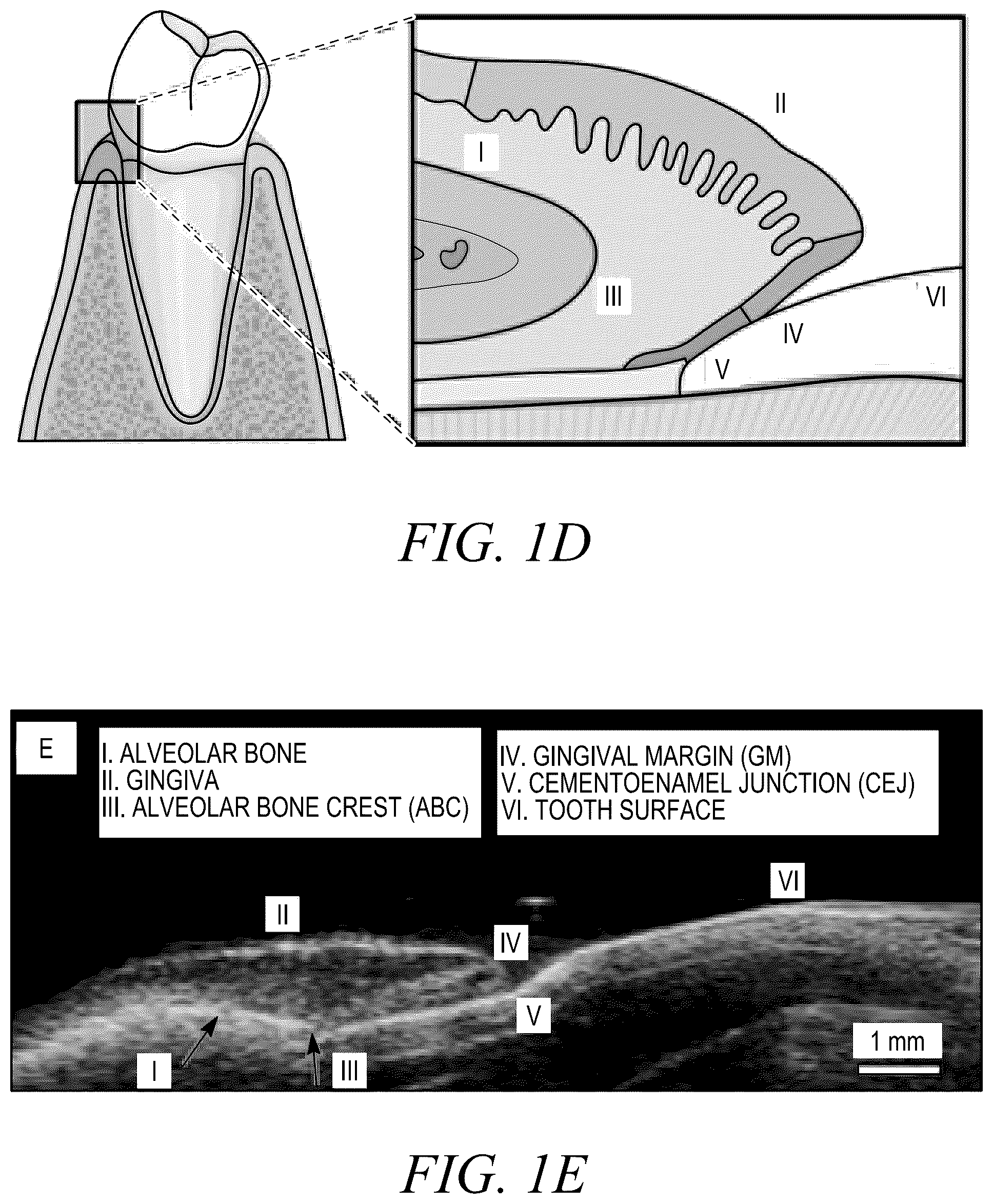 Patent US12588888 Figure 3 – High-resolution ultrasonography of gingival biomarkers for periodontal diagnosis in healthy and diseased subjects