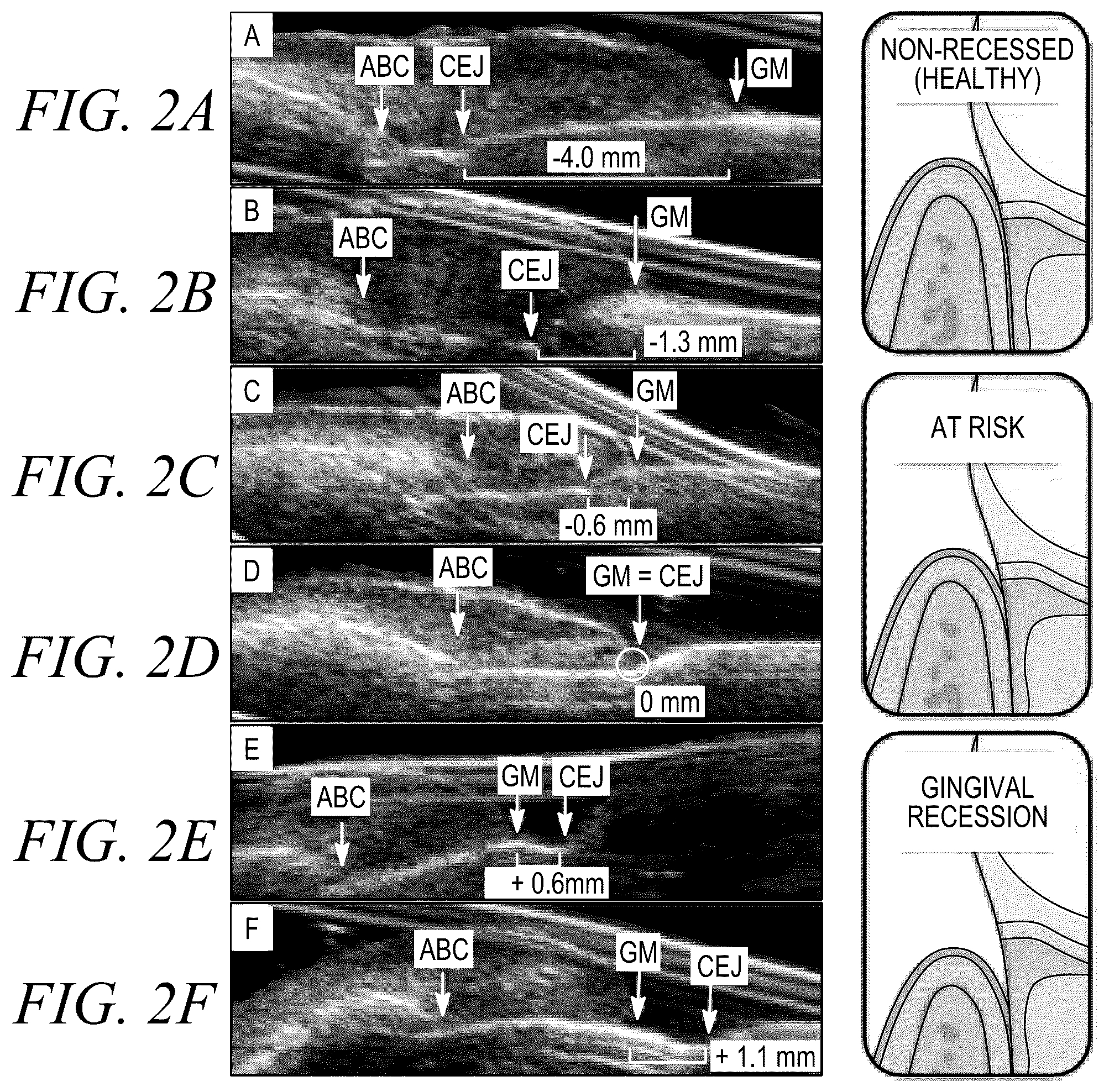Patent US12588888 Figure 4 – High-resolution ultrasonography of gingival biomarkers for periodontal diagnosis in healthy and diseased subjects