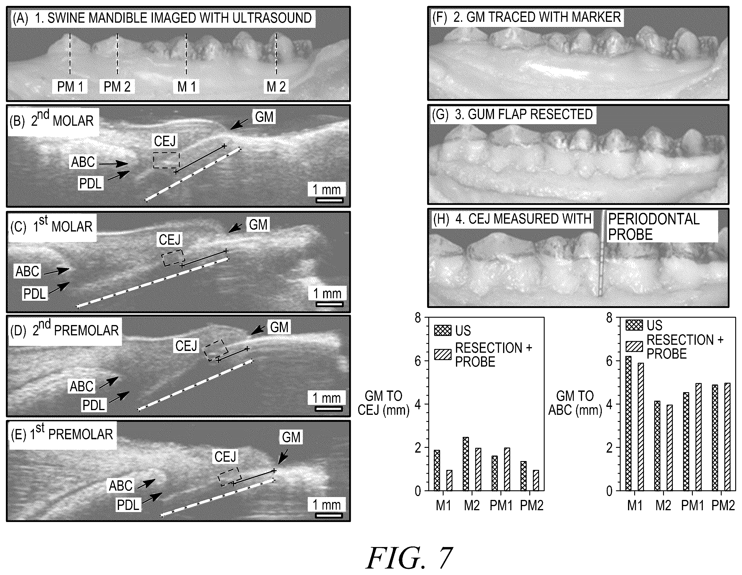 Patent US12588888 Figure 11 – High-resolution ultrasonography of gingival biomarkers for periodontal diagnosis in healthy and diseased subjects