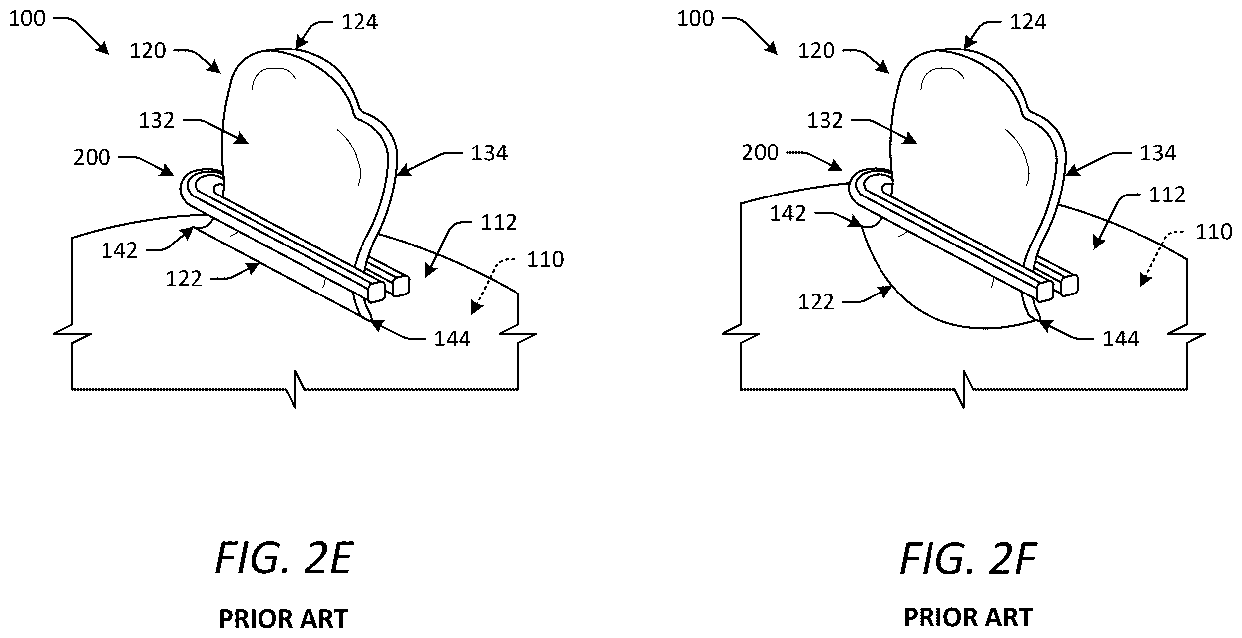 Patent US12588902 Figure 3 – Occlusion devices and methods having lateral pockets or sleeves