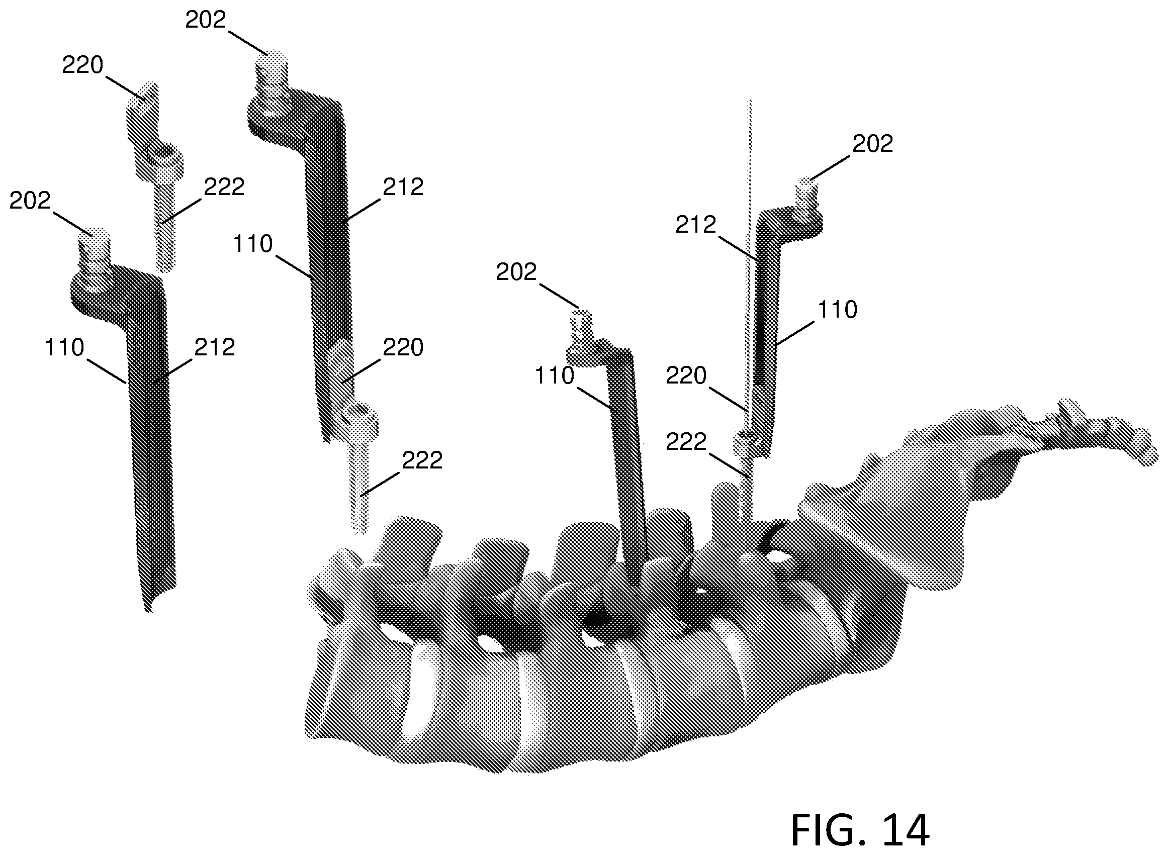 Patent US12588903 Figure 15 – Anterior to the psoas surgical access system and a modified surgical approach technique