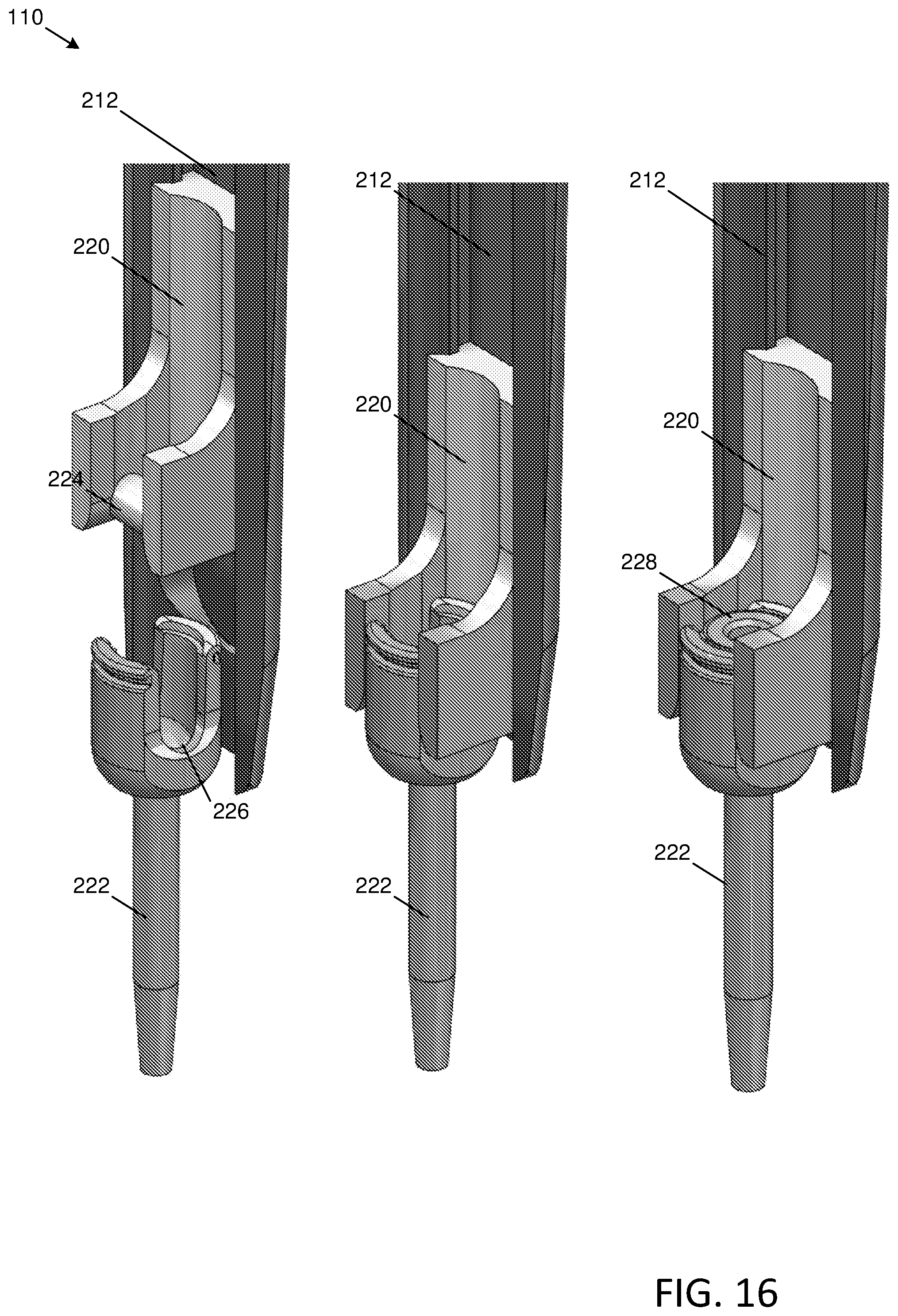 Patent US12588903 Figure 17 – Anterior to the psoas surgical access system and a modified surgical approach technique