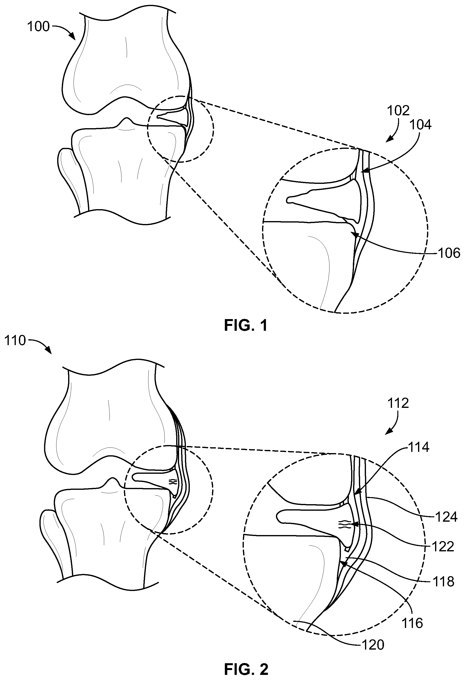 Patent US12588905 Figure 1 – Knee joint capsular disruption and repair