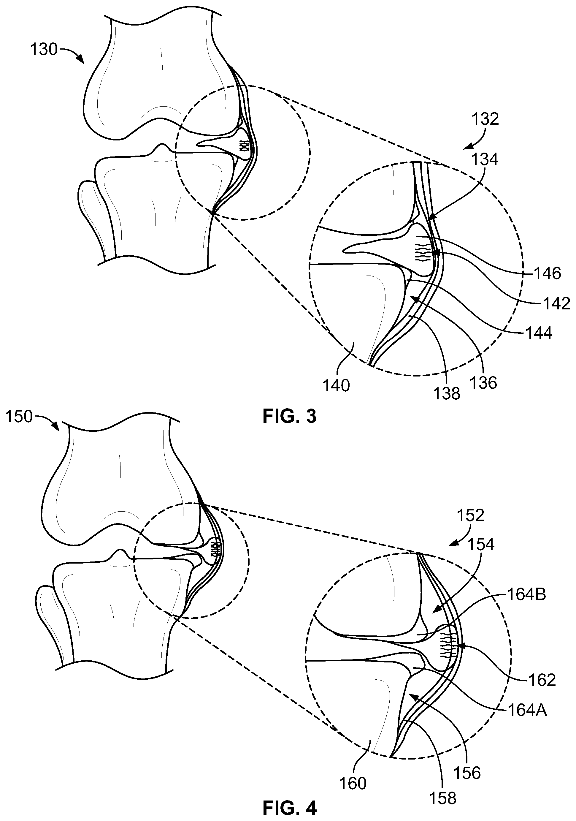 Patent US12588905 Figure 2 – Knee joint capsular disruption and repair