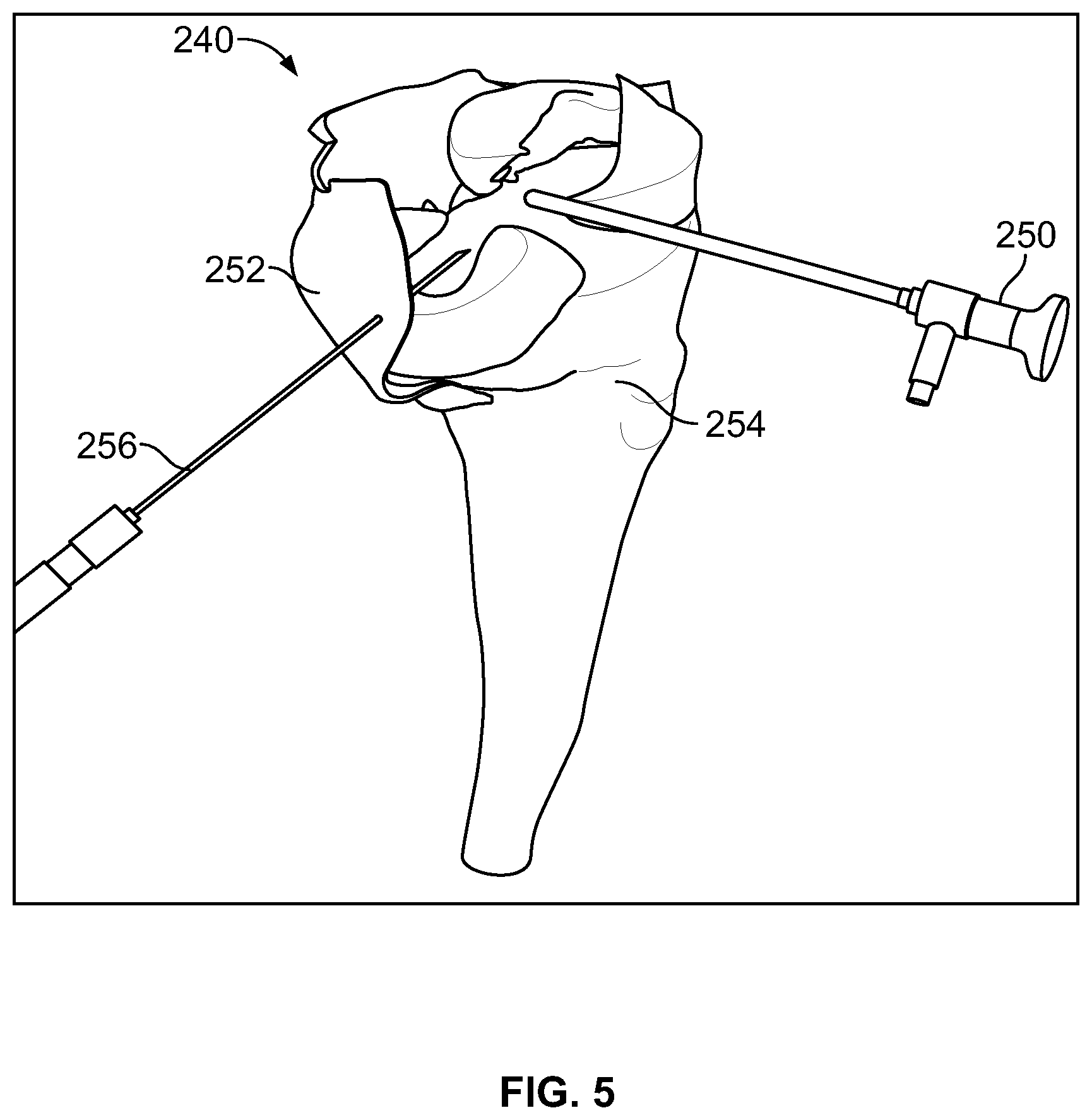 Patent US12588905 Figure 3 – Knee joint capsular disruption and repair