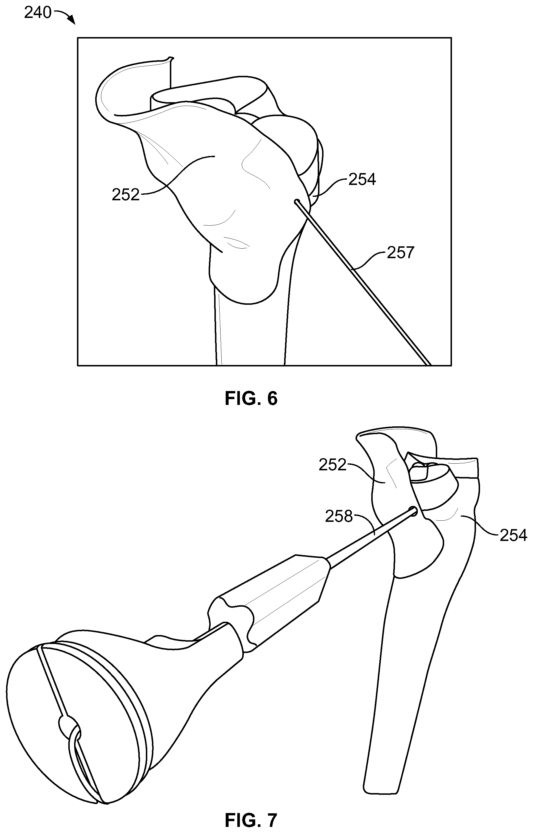 Patent US12588905 Figure 4 – Knee joint capsular disruption and repair