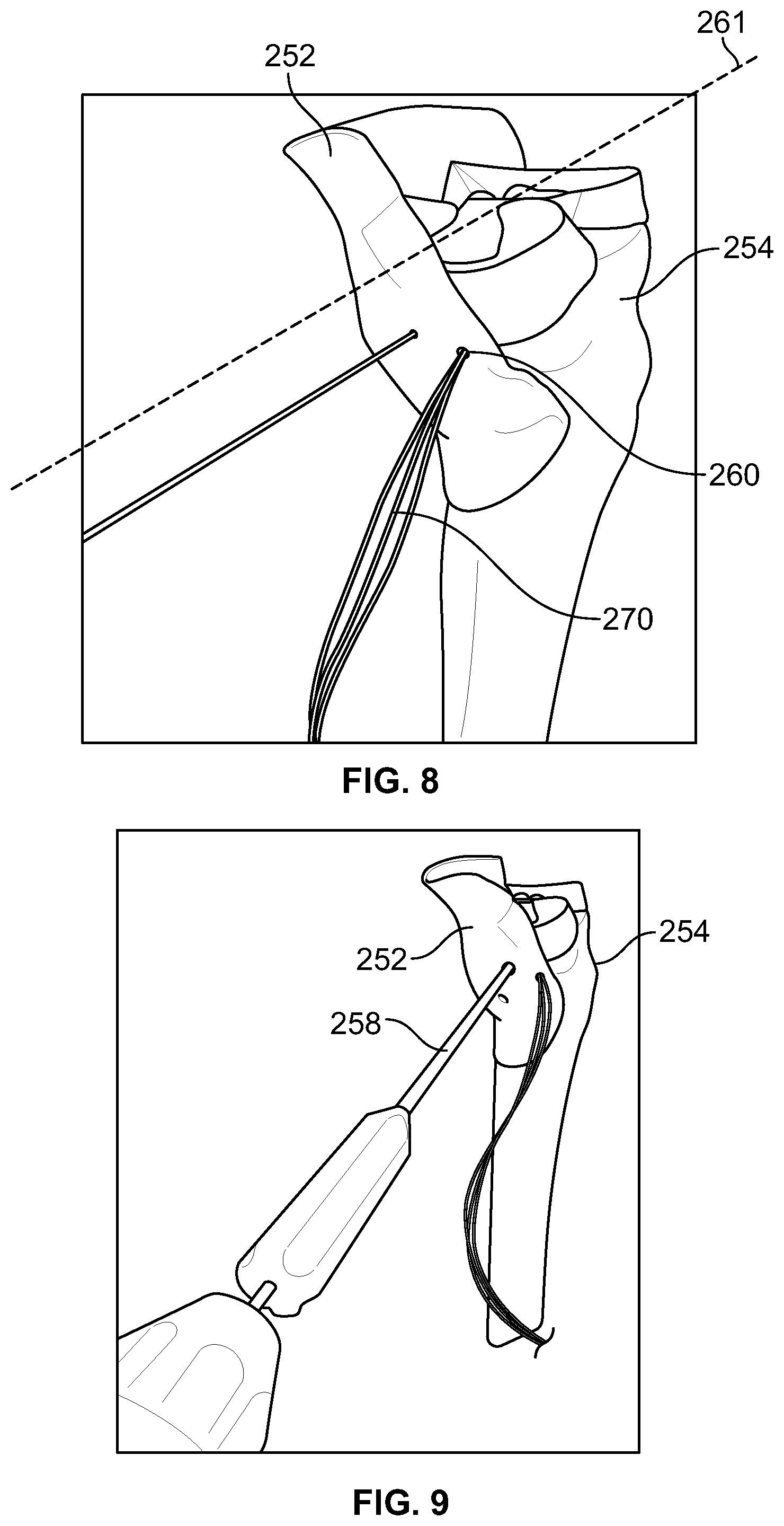 Patent US12588905 Figure 5 – Knee joint capsular disruption and repair