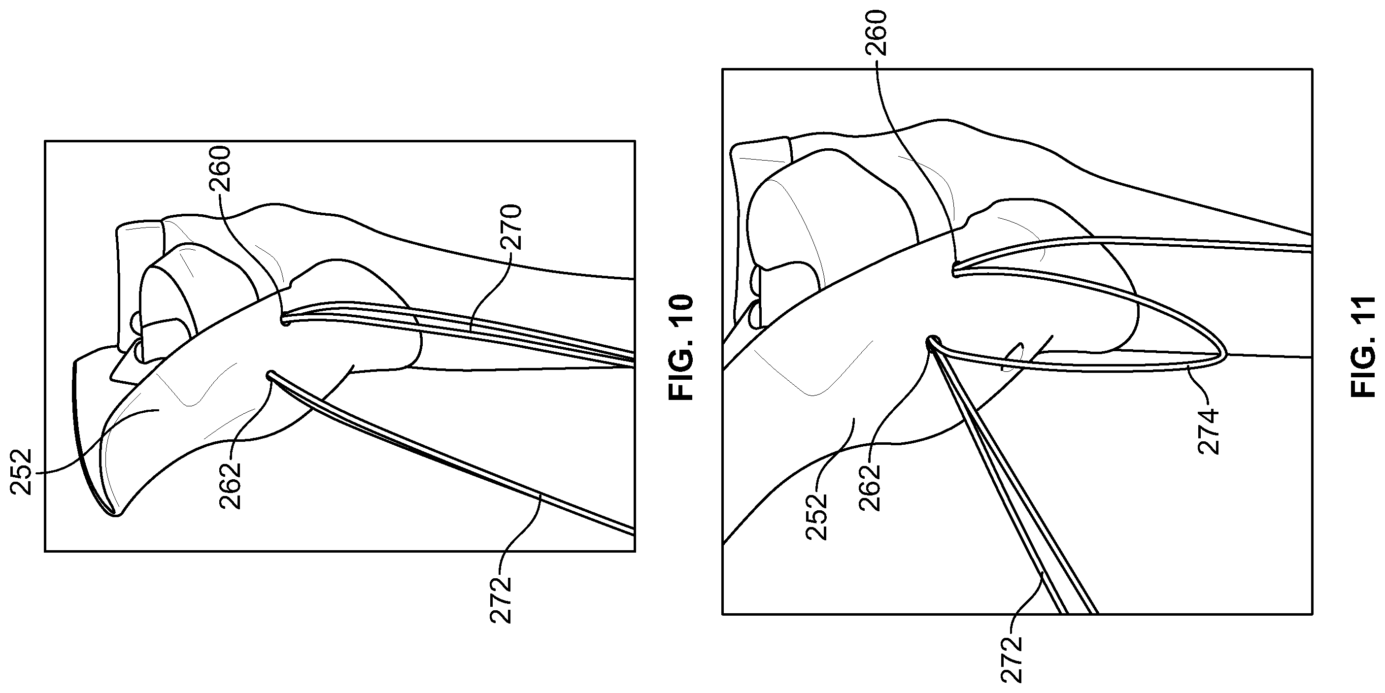 Patent US12588905 Figure 6 – Knee joint capsular disruption and repair