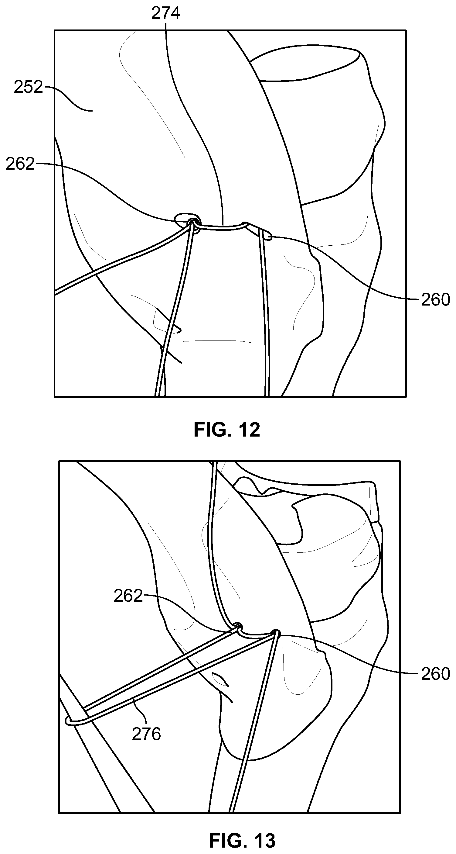 Patent US12588905 Figure 7 – Knee joint capsular disruption and repair