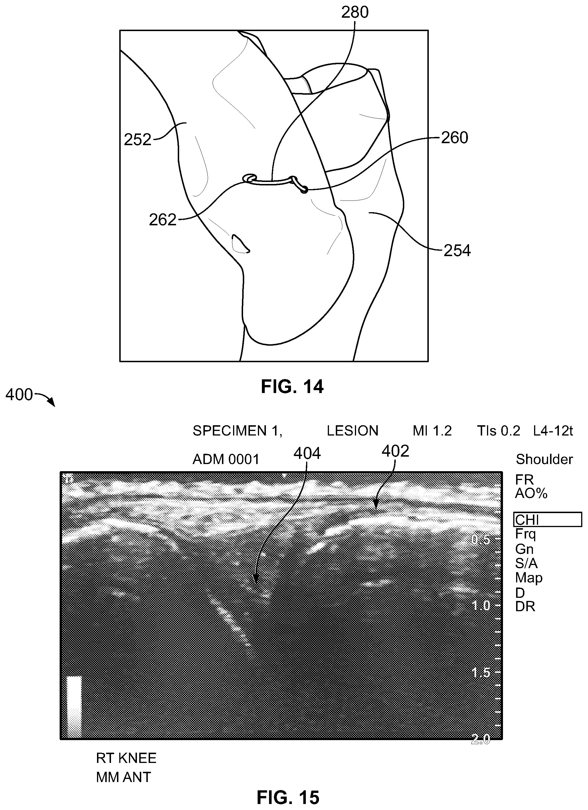 Patent US12588905 Figure 8 – Knee joint capsular disruption and repair