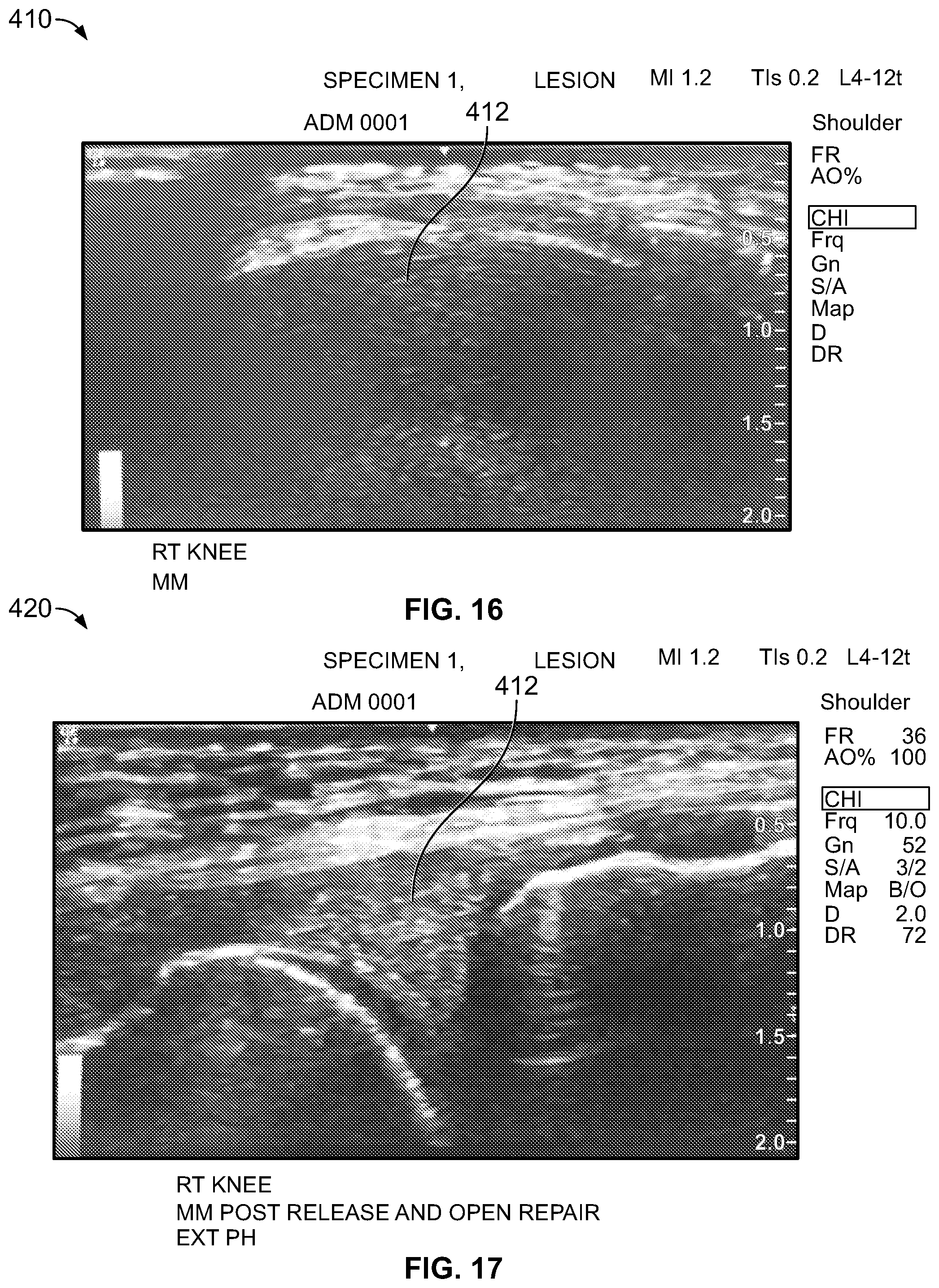 Patent US12588905 Figure 9 – Knee joint capsular disruption and repair