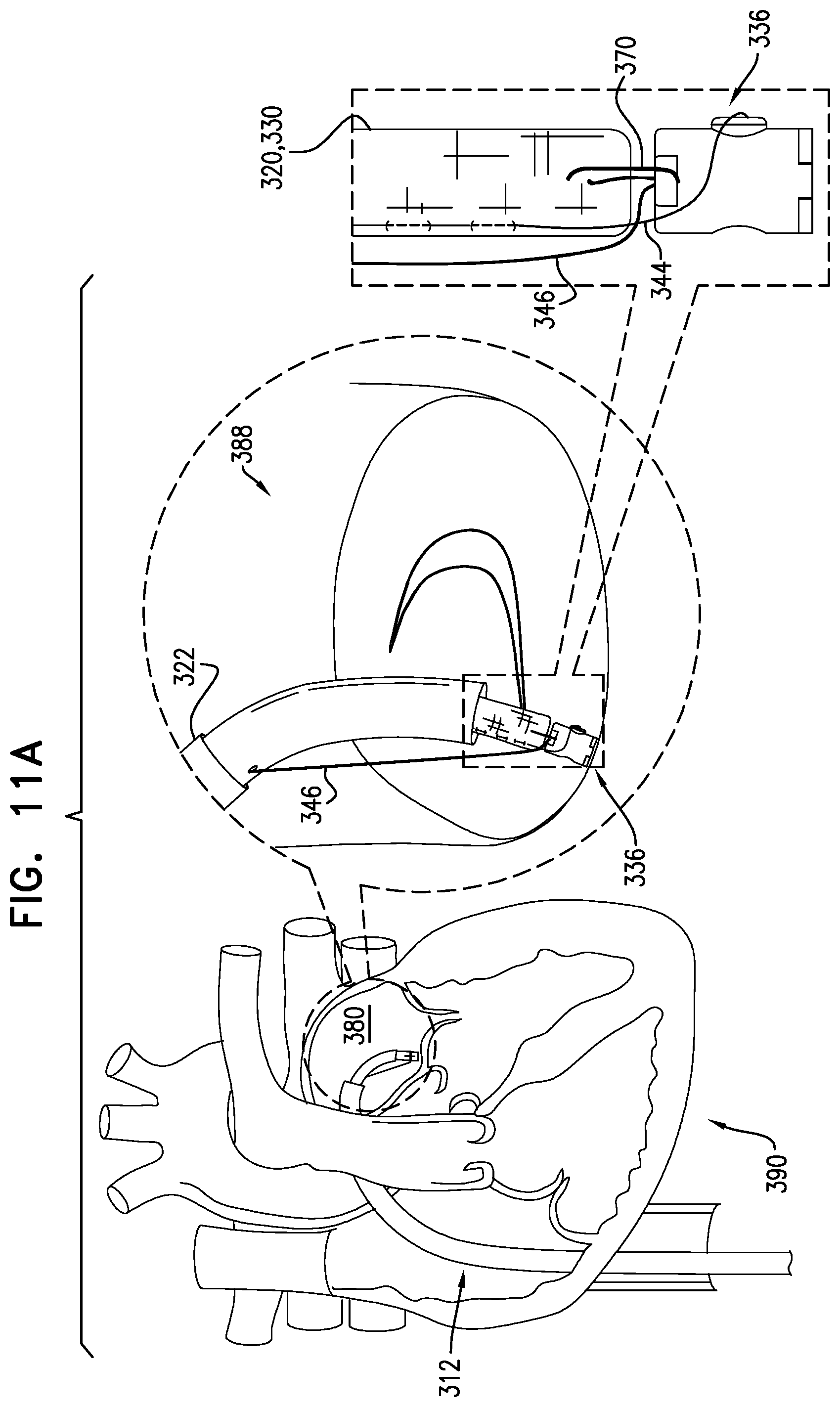 Patent US12588907 Figure 16 – Self-locking winch