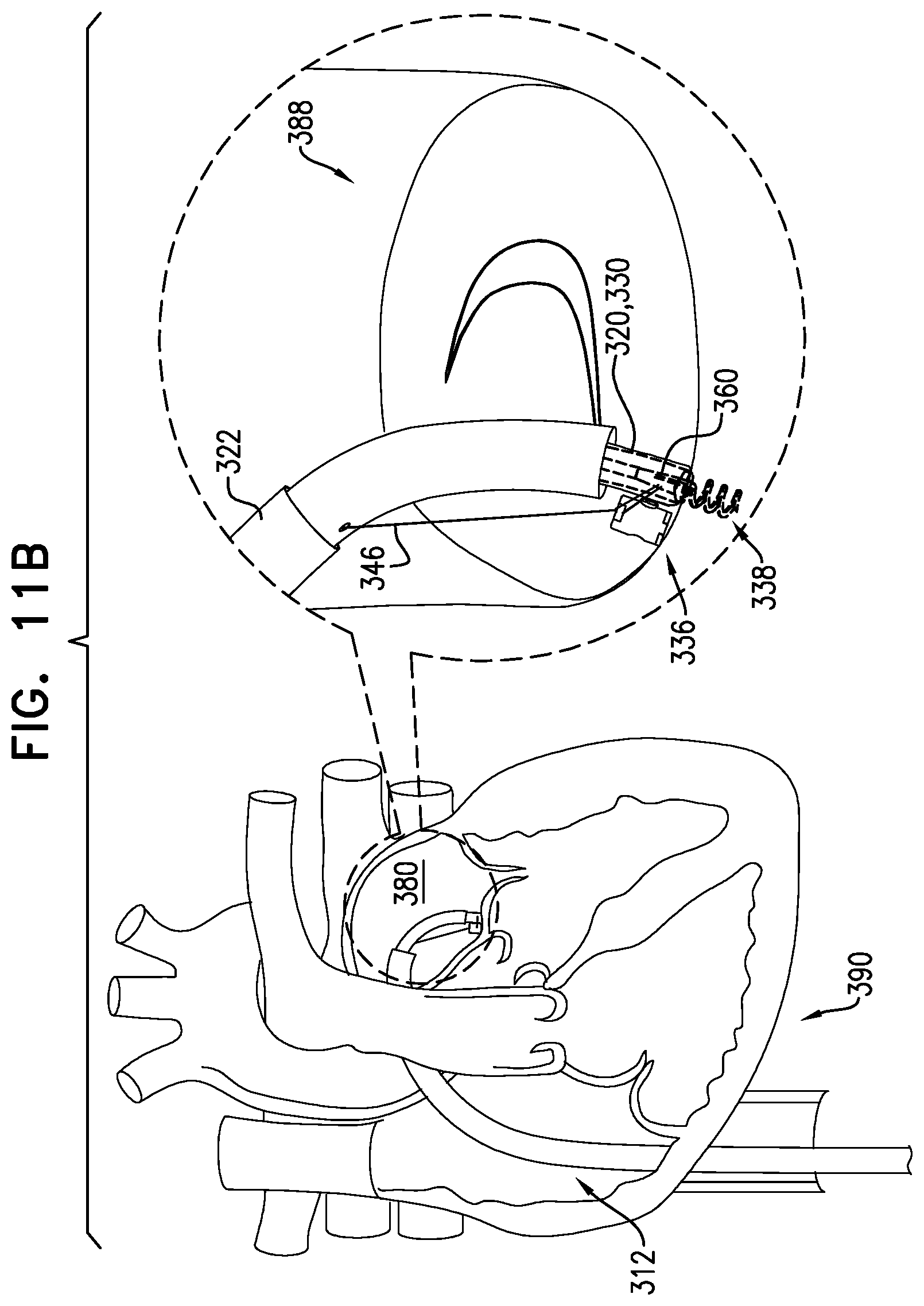 Patent US12588907 Figure 17 – Self-locking winch