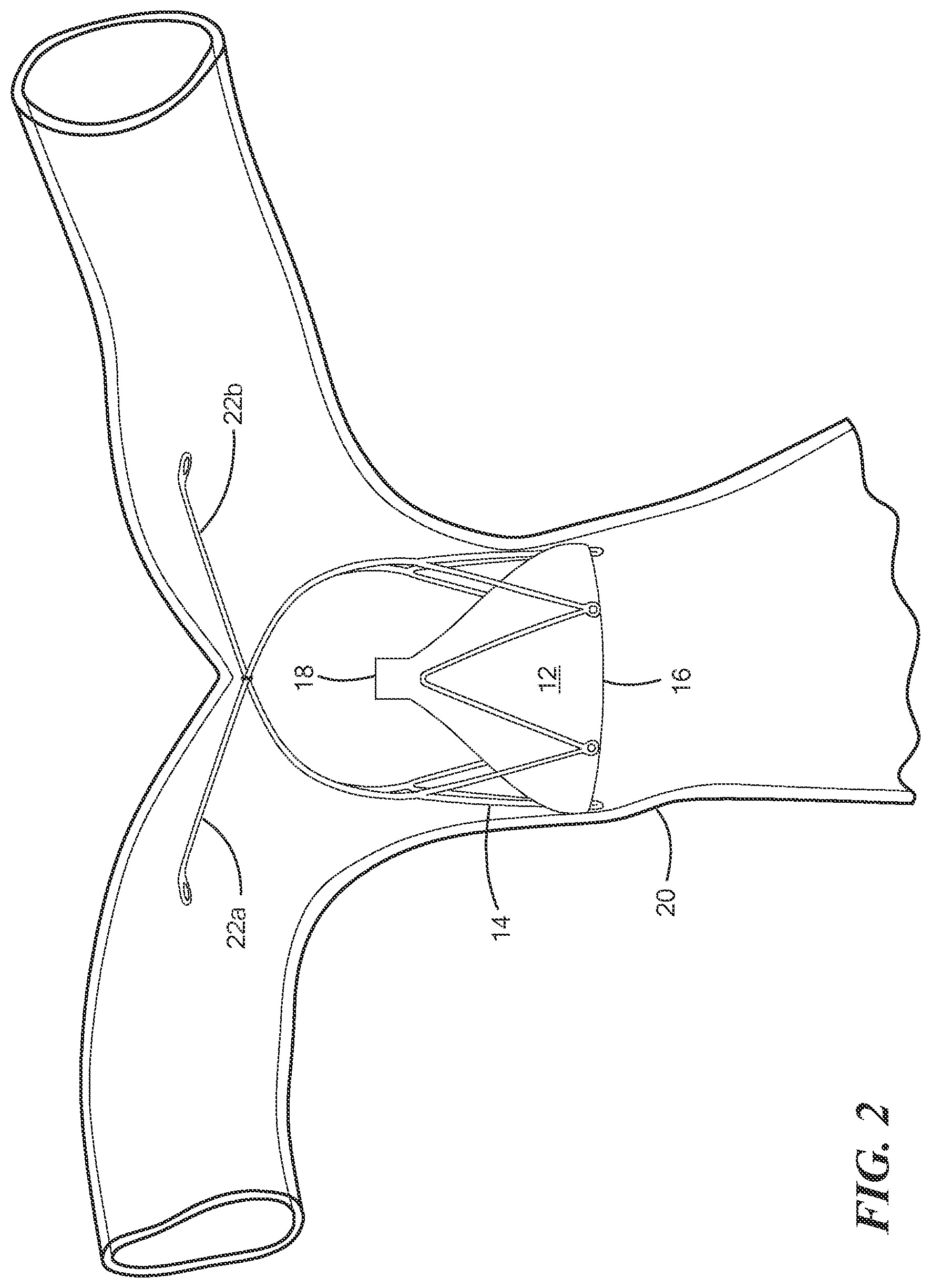 Patent US12588909 Figure 2 – Transcatheter device and minimally invasive method for constricting and adjusting blood flow through a blood vessel