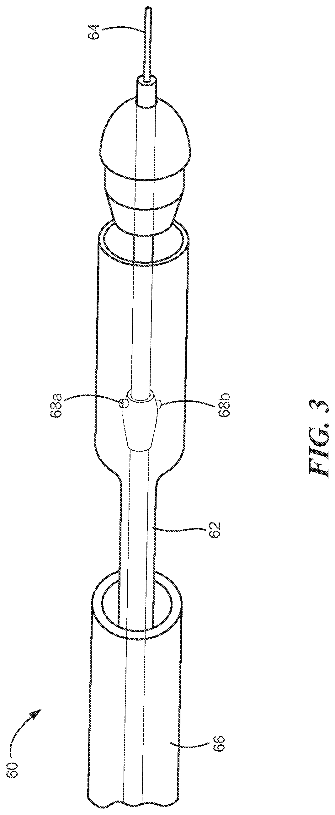 Patent US12588909 Figure 3 – Transcatheter device and minimally invasive method for constricting and adjusting blood flow through a blood vessel
