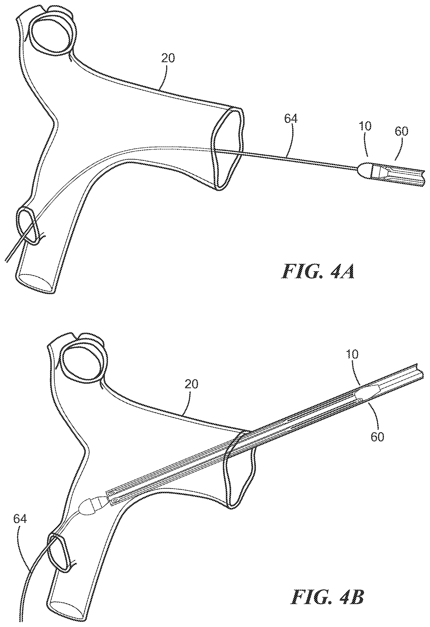 Patent US12588909 Figure 4 – Transcatheter device and minimally invasive method for constricting and adjusting blood flow through a blood vessel