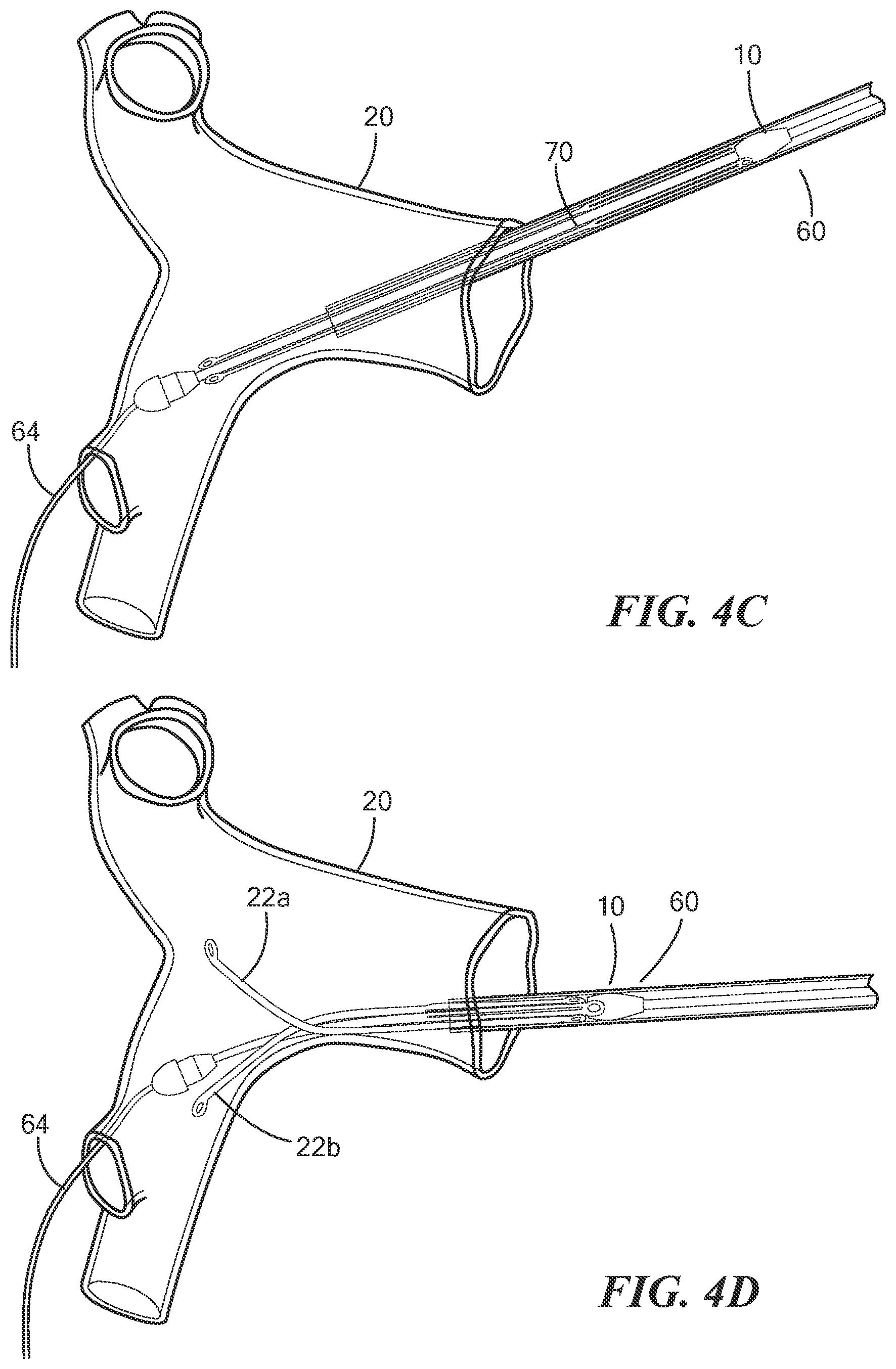 Patent US12588909 Figure 5 – Transcatheter device and minimally invasive method for constricting and adjusting blood flow through a blood vessel