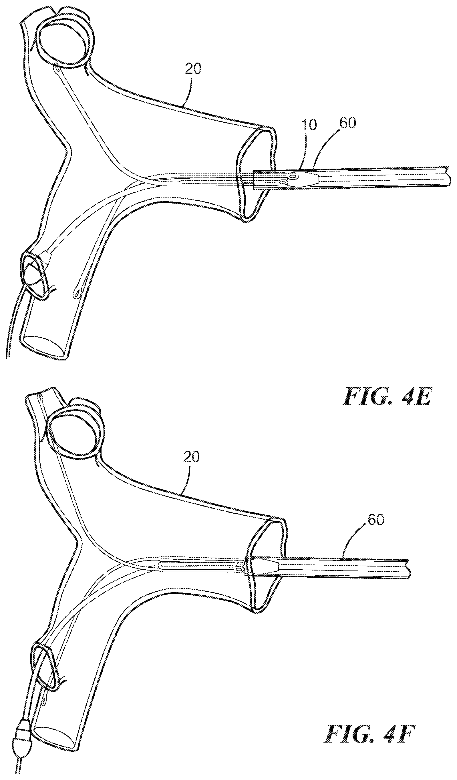 Patent US12588909 Figure 6 – Transcatheter device and minimally invasive method for constricting and adjusting blood flow through a blood vessel