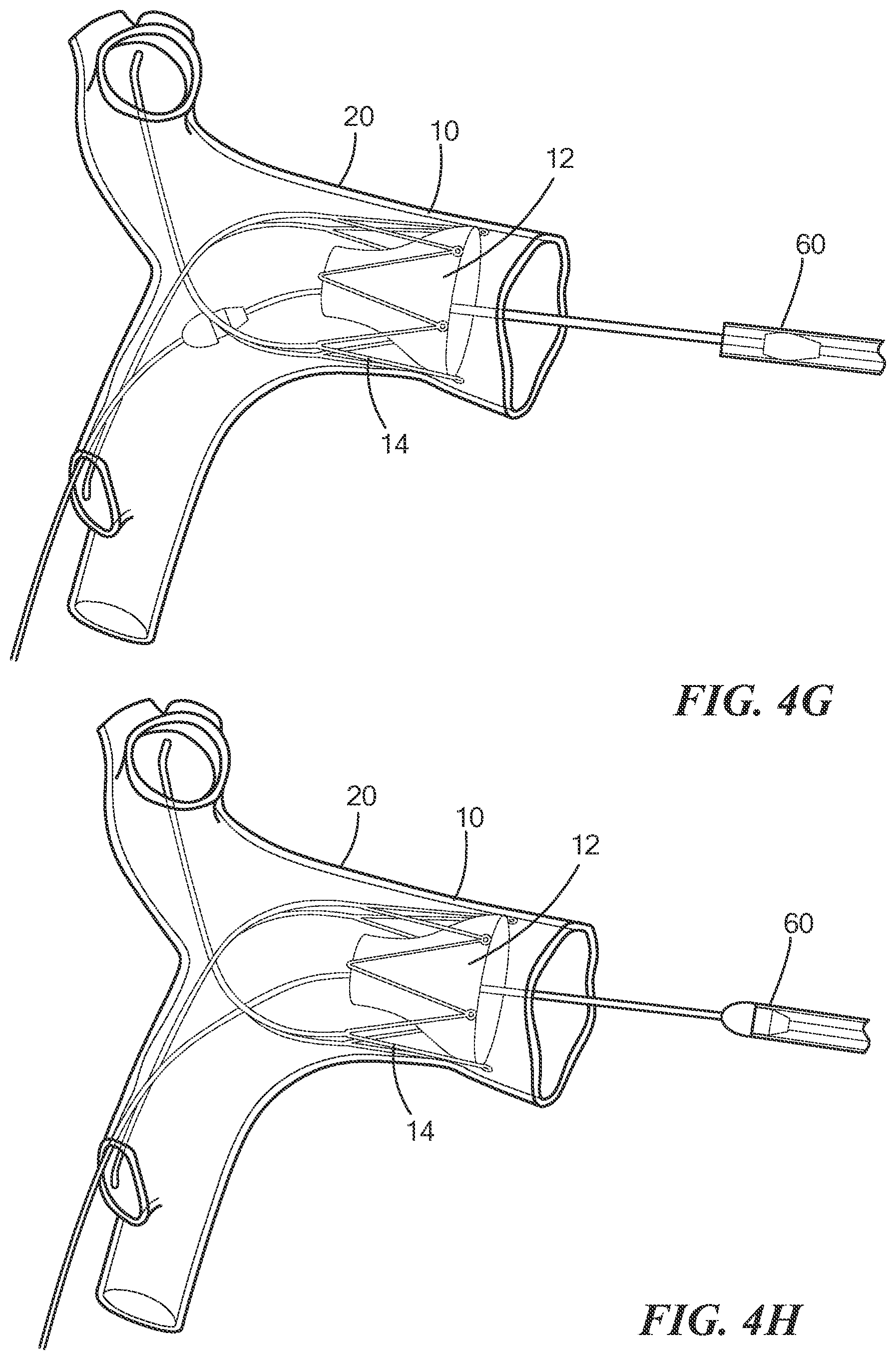 Patent US12588909 Figure 7 – Transcatheter device and minimally invasive method for constricting and adjusting blood flow through a blood vessel