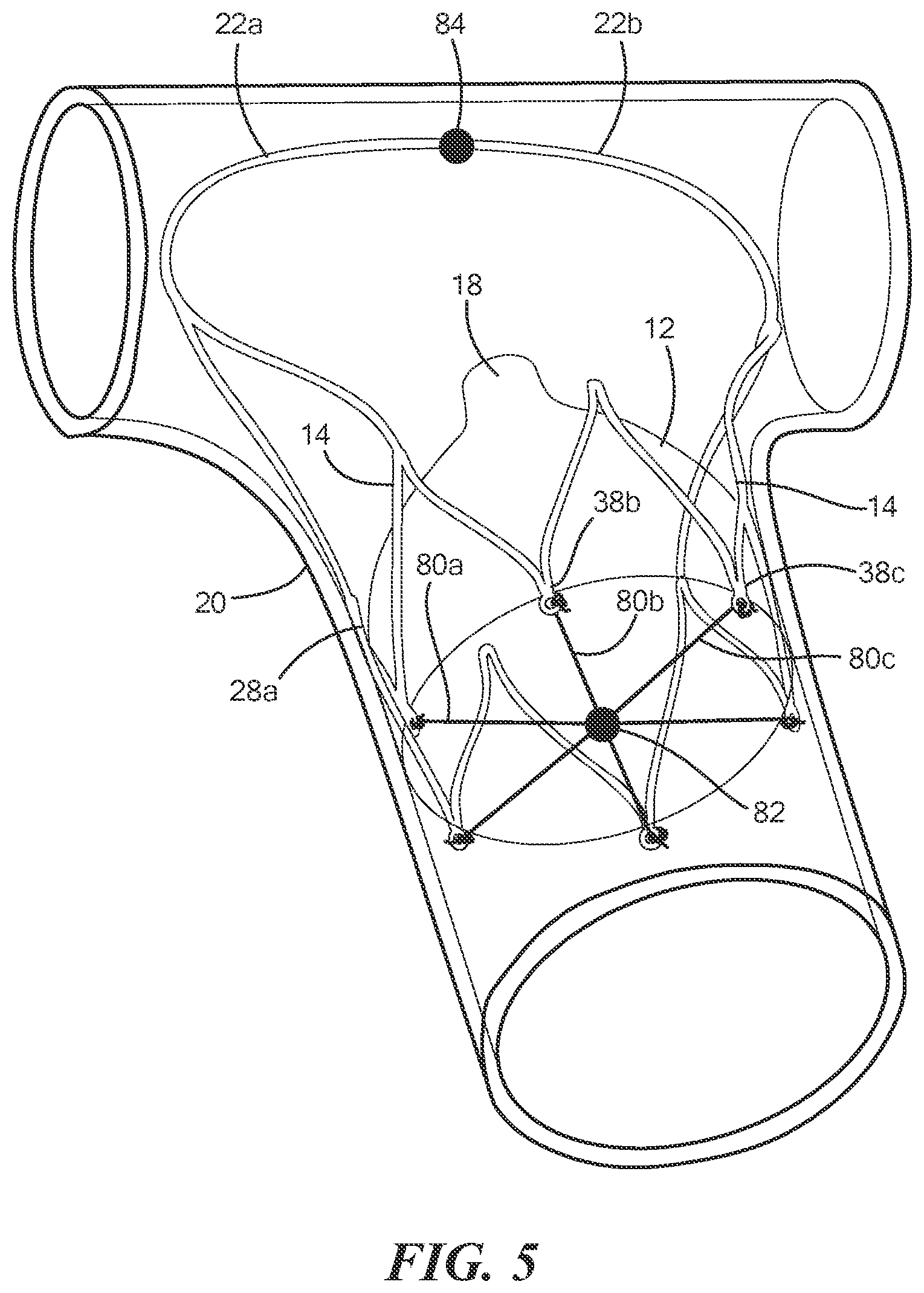 Patent US12588909 Figure 8 – Transcatheter device and minimally invasive method for constricting and adjusting blood flow through a blood vessel