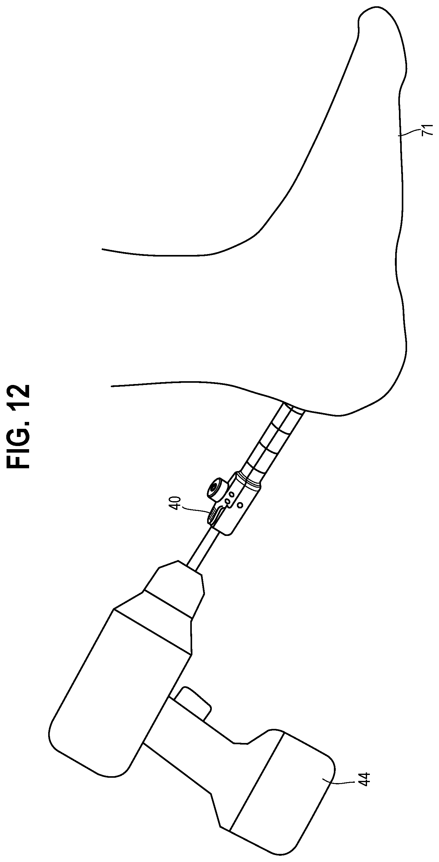 Patent US12588913 Figure 8 – Bone graft harvesting apparatus