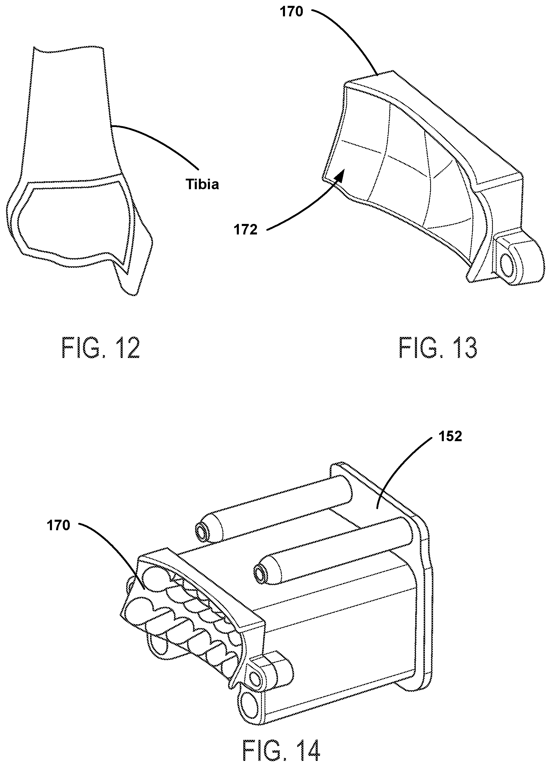 Patent US12588915 Figure 6 – Bone resection method by plunge milling and rasping during total ankle arthroplasty