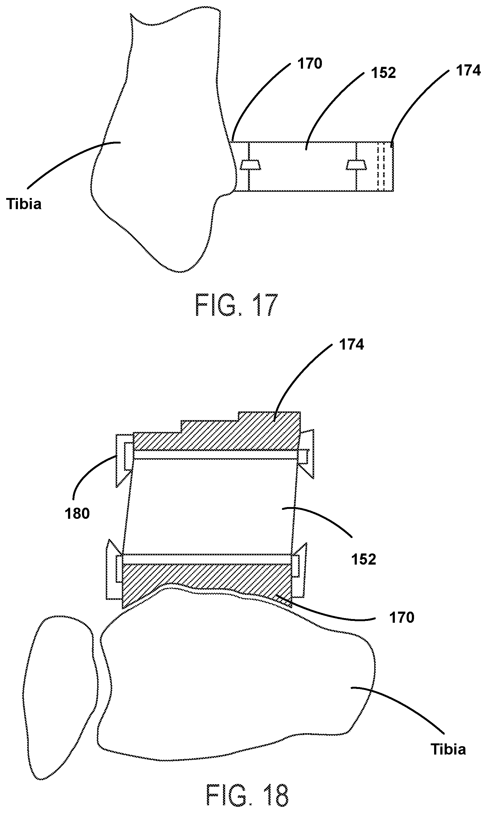 Patent US12588915 Figure 8 – Bone resection method by plunge milling and rasping during total ankle arthroplasty