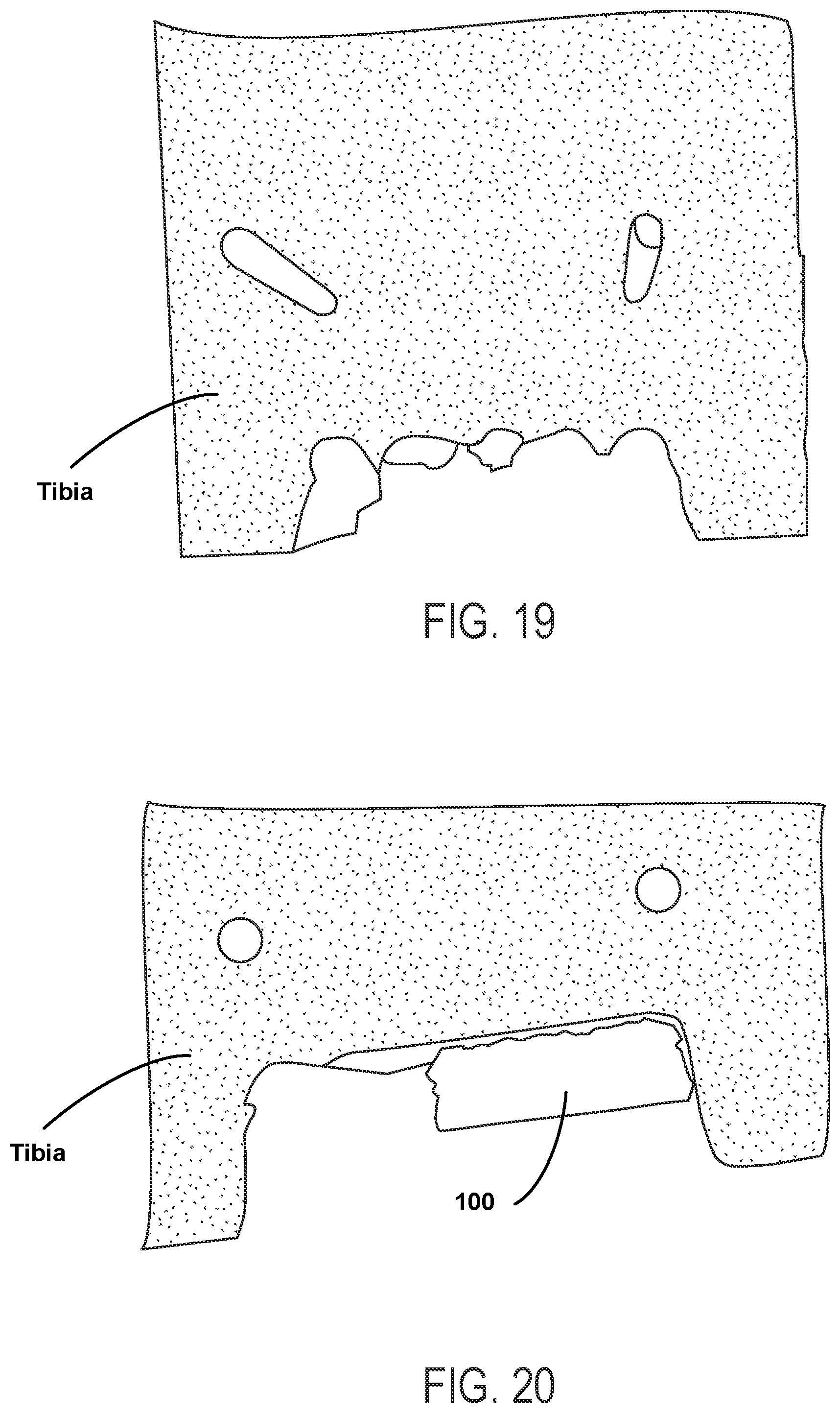 Patent US12588915 Figure 9 – Bone resection method by plunge milling and rasping during total ankle arthroplasty
