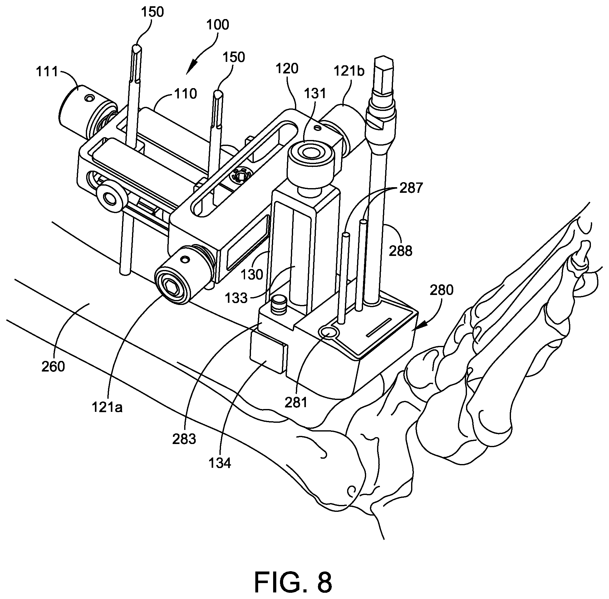 Patent US12588916 Figure 6 – Ankle replacement system and method