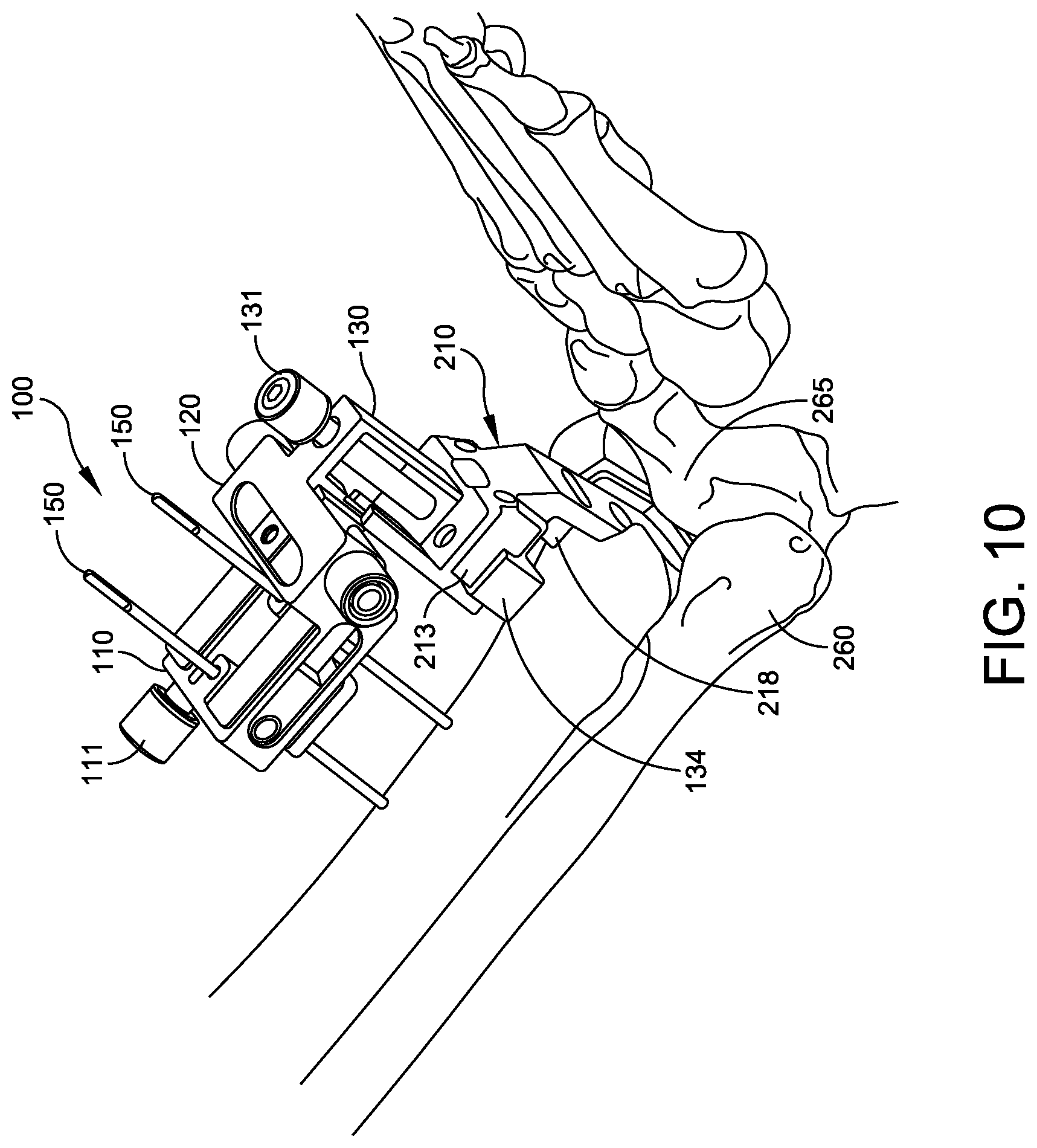 Patent US12588916 Figure 8 – Ankle replacement system and method
