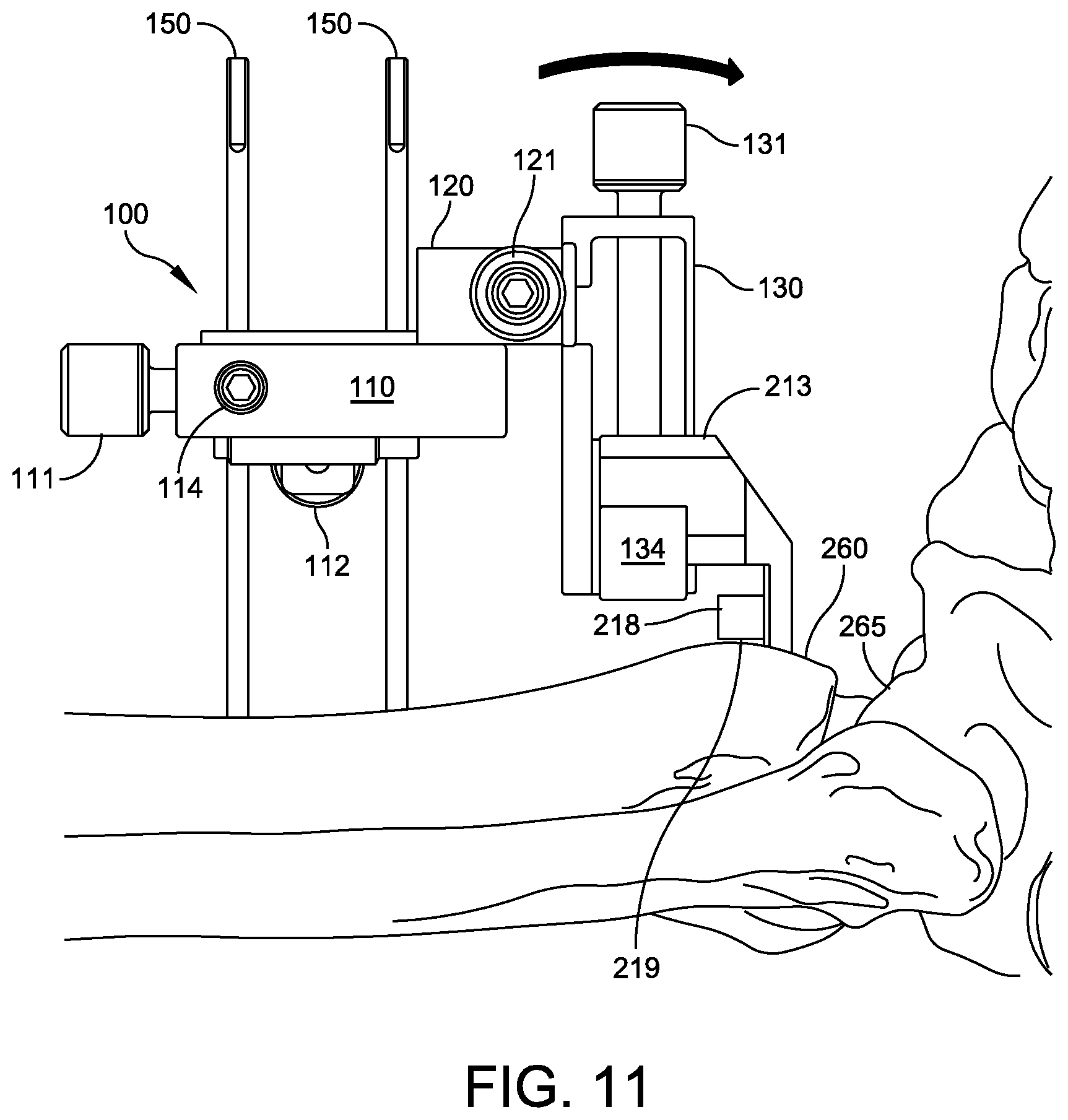 Patent US12588916 Figure 9 – Ankle replacement system and method