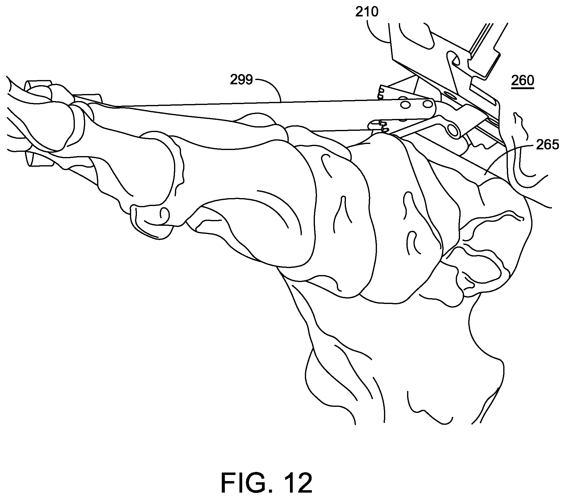 Patent US12588916 Figure 10 – Ankle replacement system and method