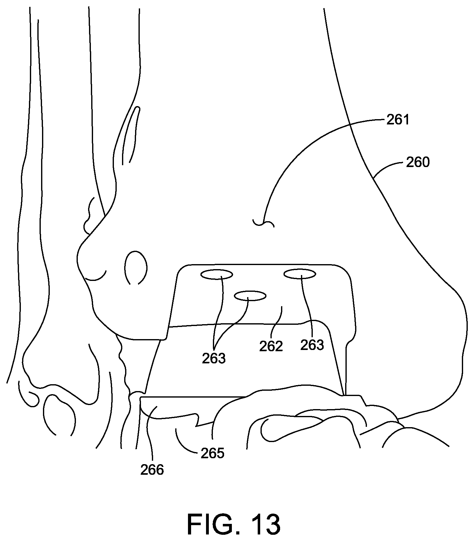 Patent US12588916 Figure 11 – Ankle replacement system and method