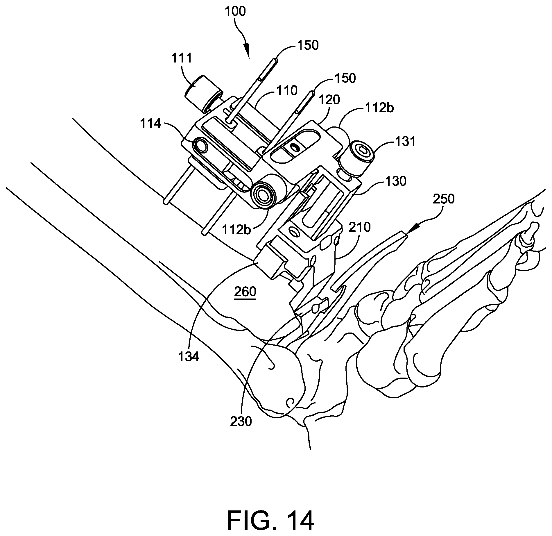 Patent US12588916 Figure 12 – Ankle replacement system and method