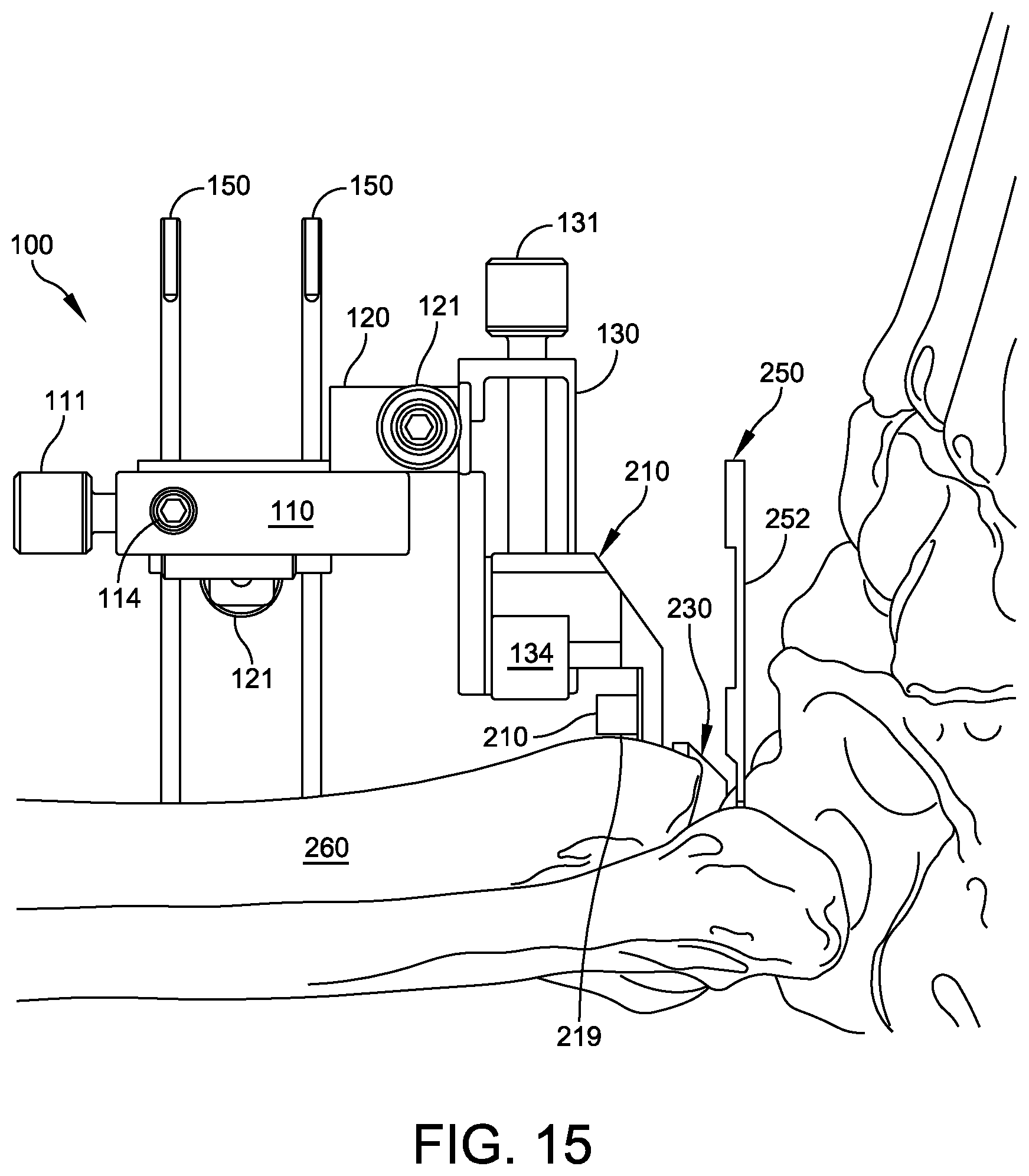 Patent US12588916 Figure 13 – Ankle replacement system and method