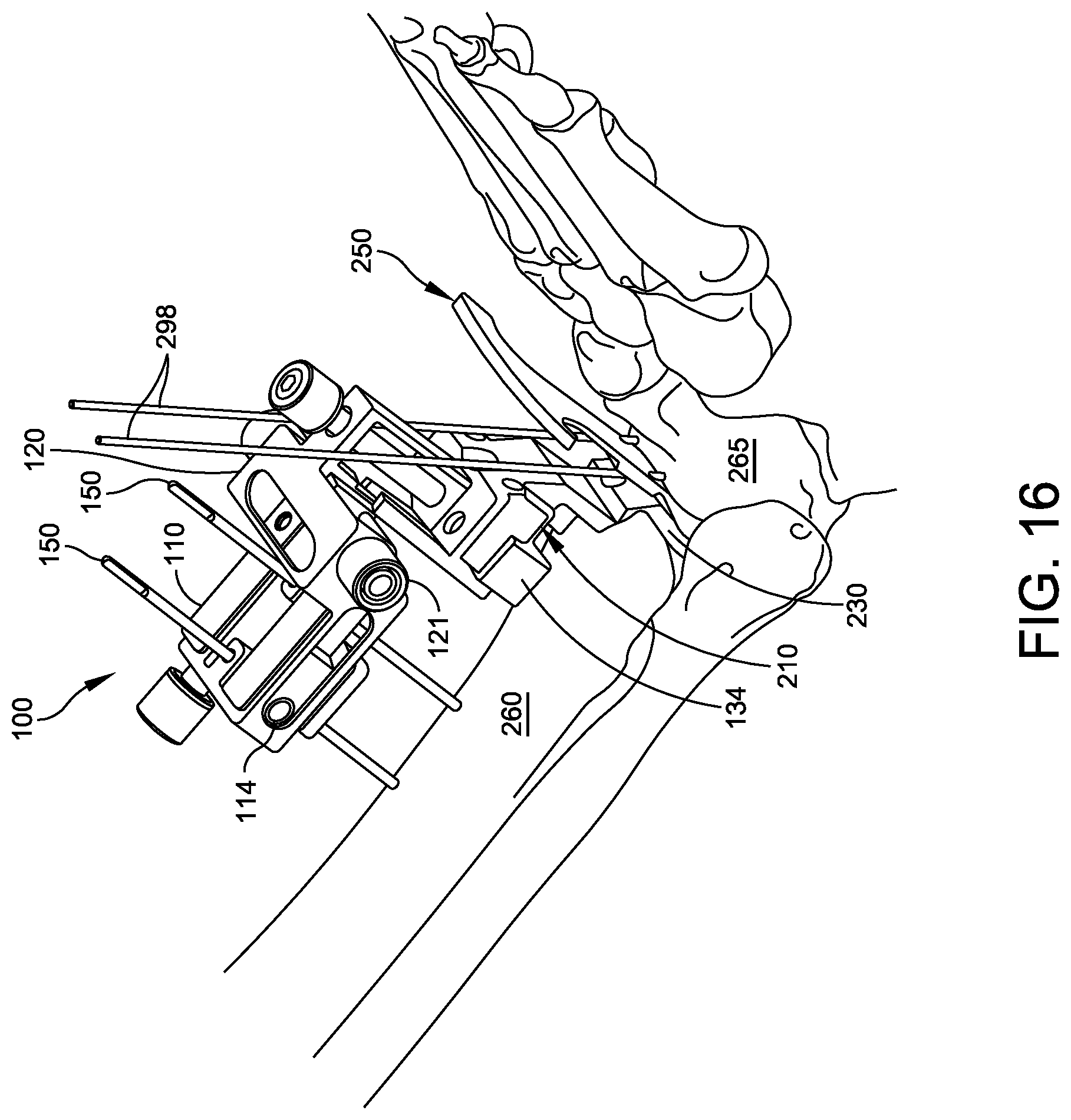 Patent US12588916 Figure 14 – Ankle replacement system and method