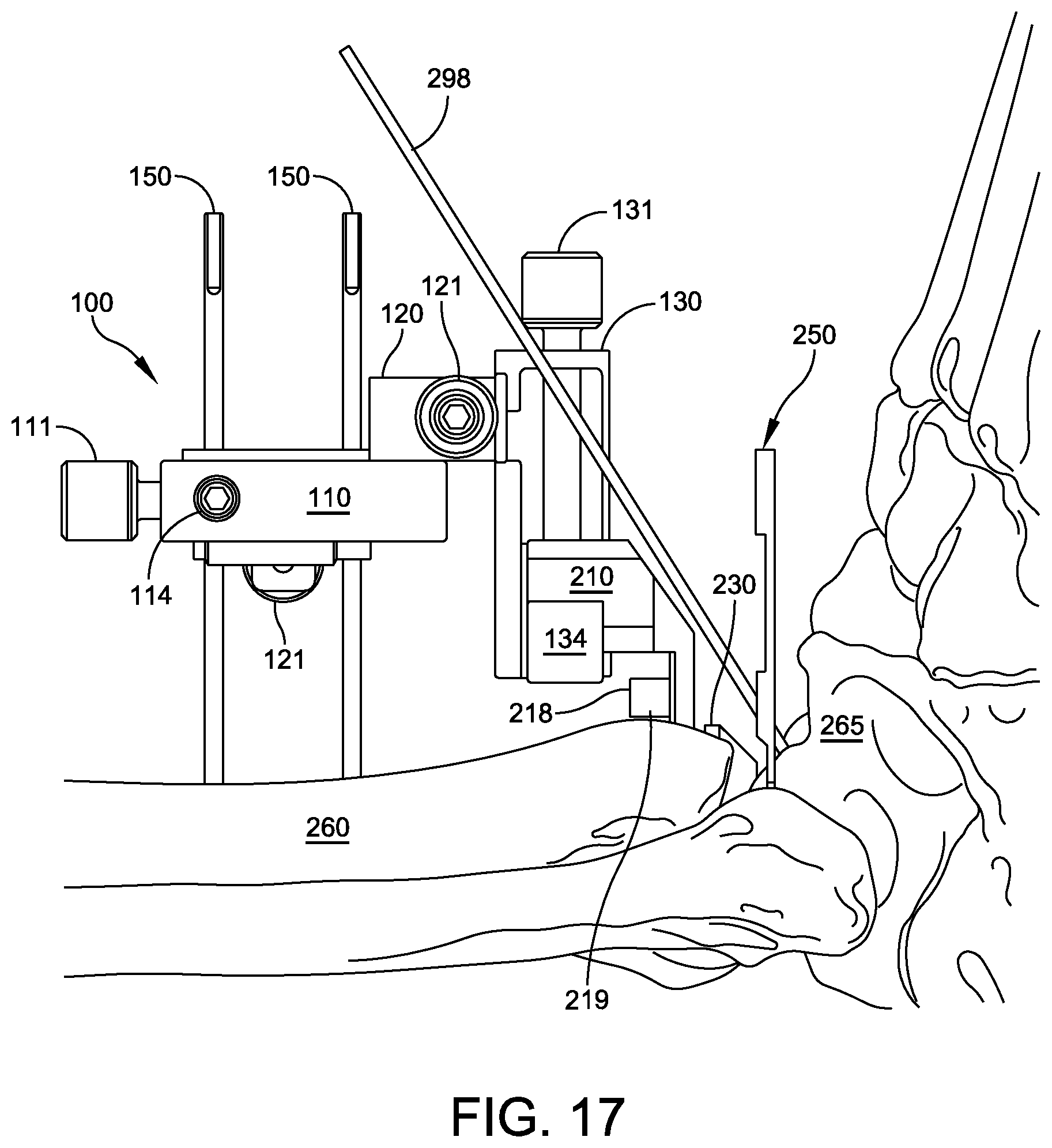 Patent US12588916 Figure 15 – Ankle replacement system and method