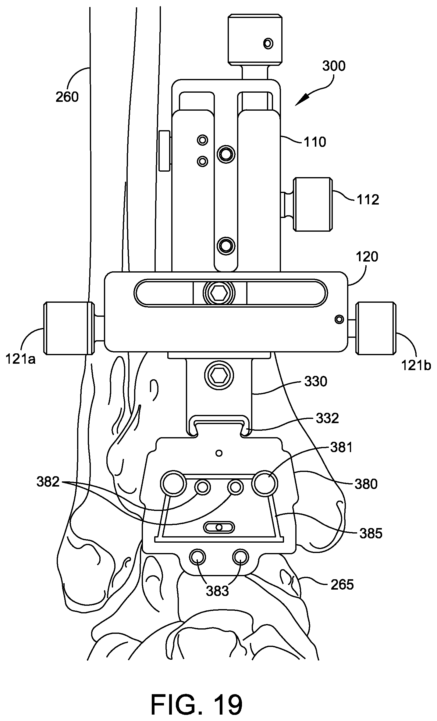 Patent US12588916 Figure 17 – Ankle replacement system and method
