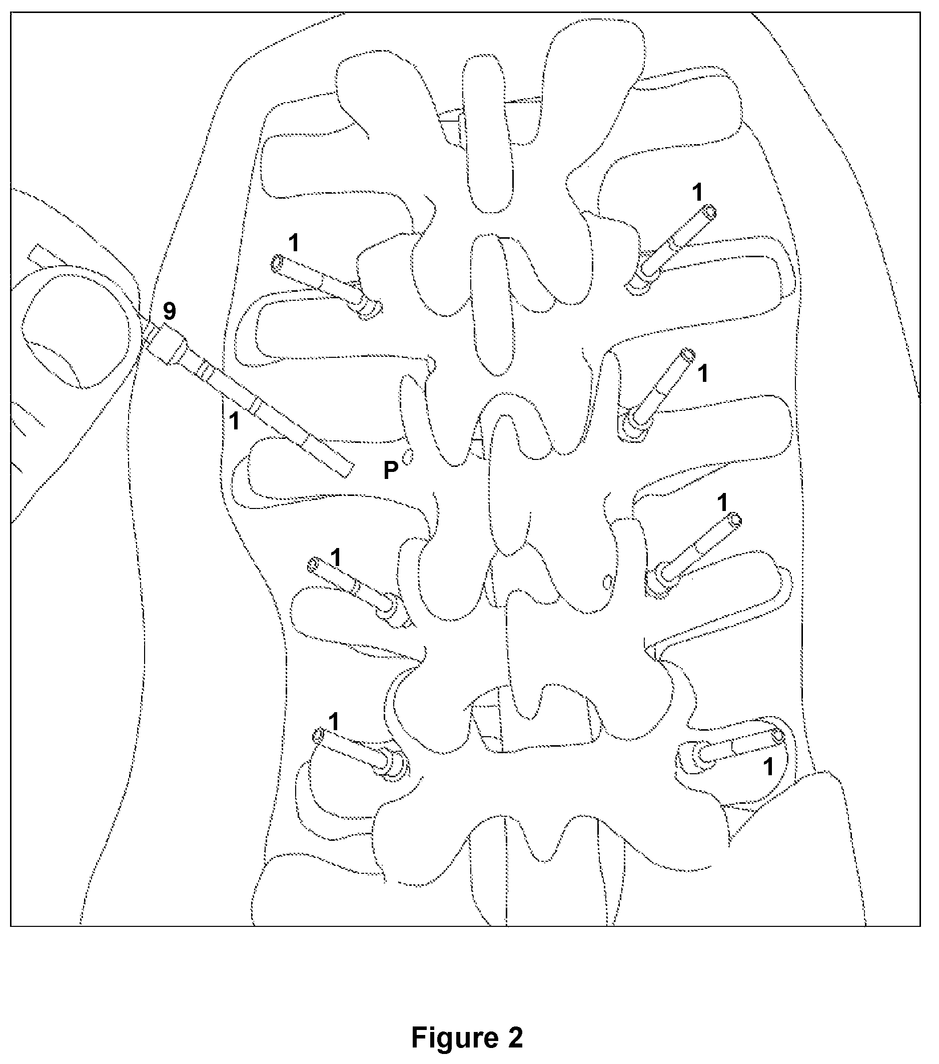 Patent US12588917 Figure 3 – Pedicle marker