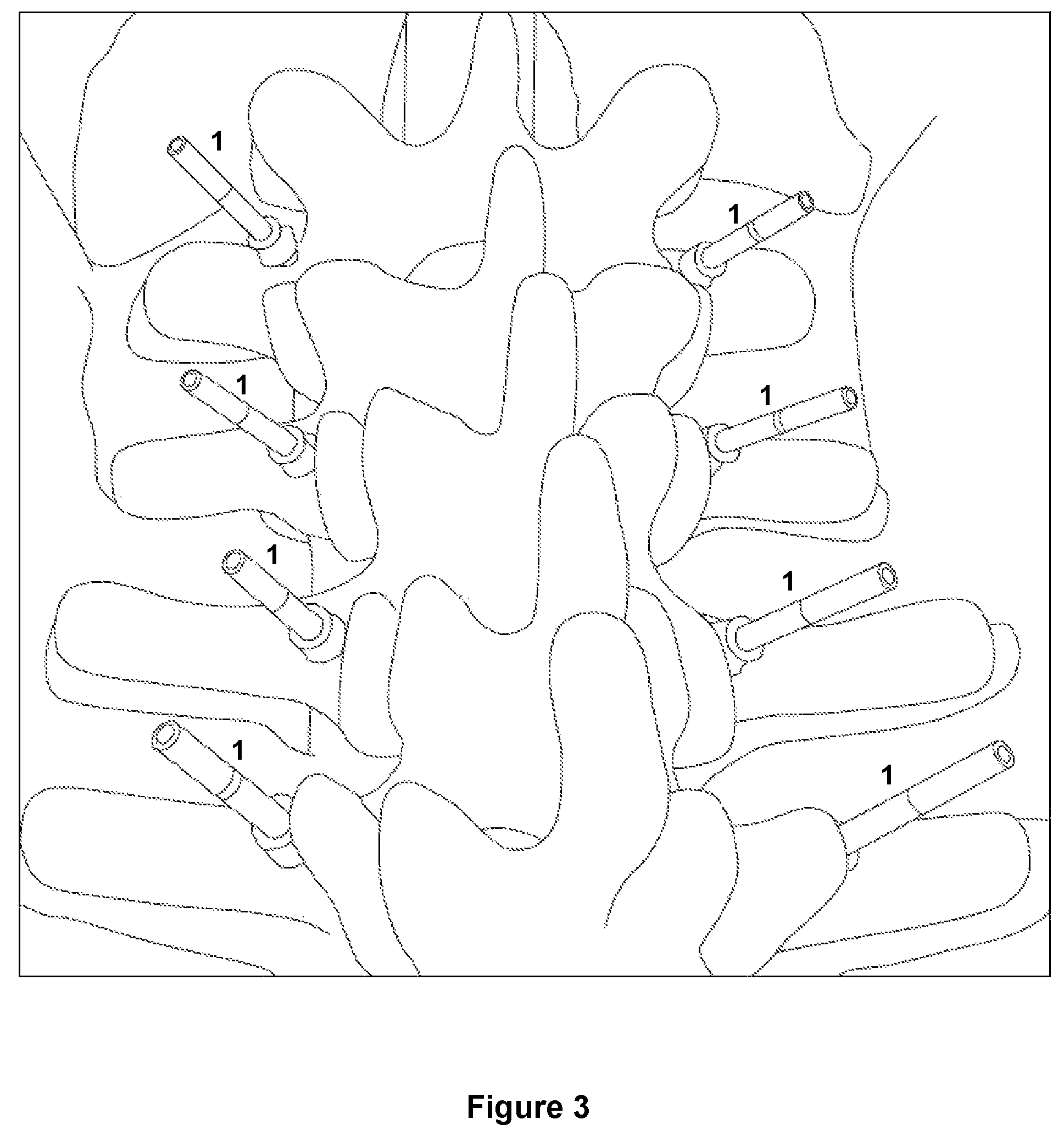 Patent US12588917 Figure 4 – Pedicle marker
