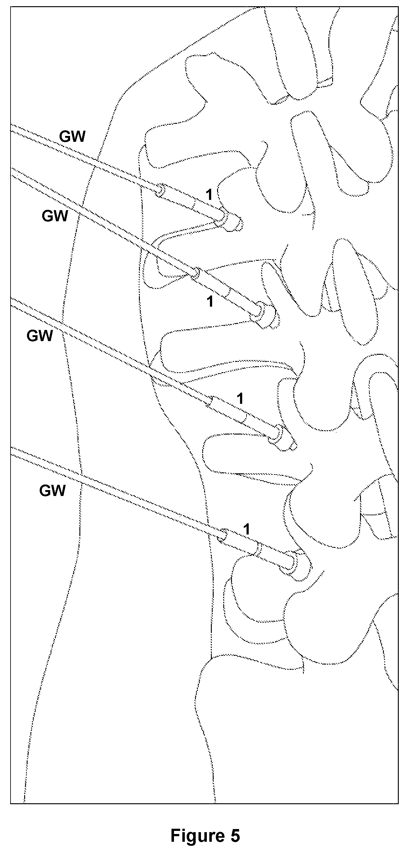 Patent US12588917 Figure 6 – Pedicle marker