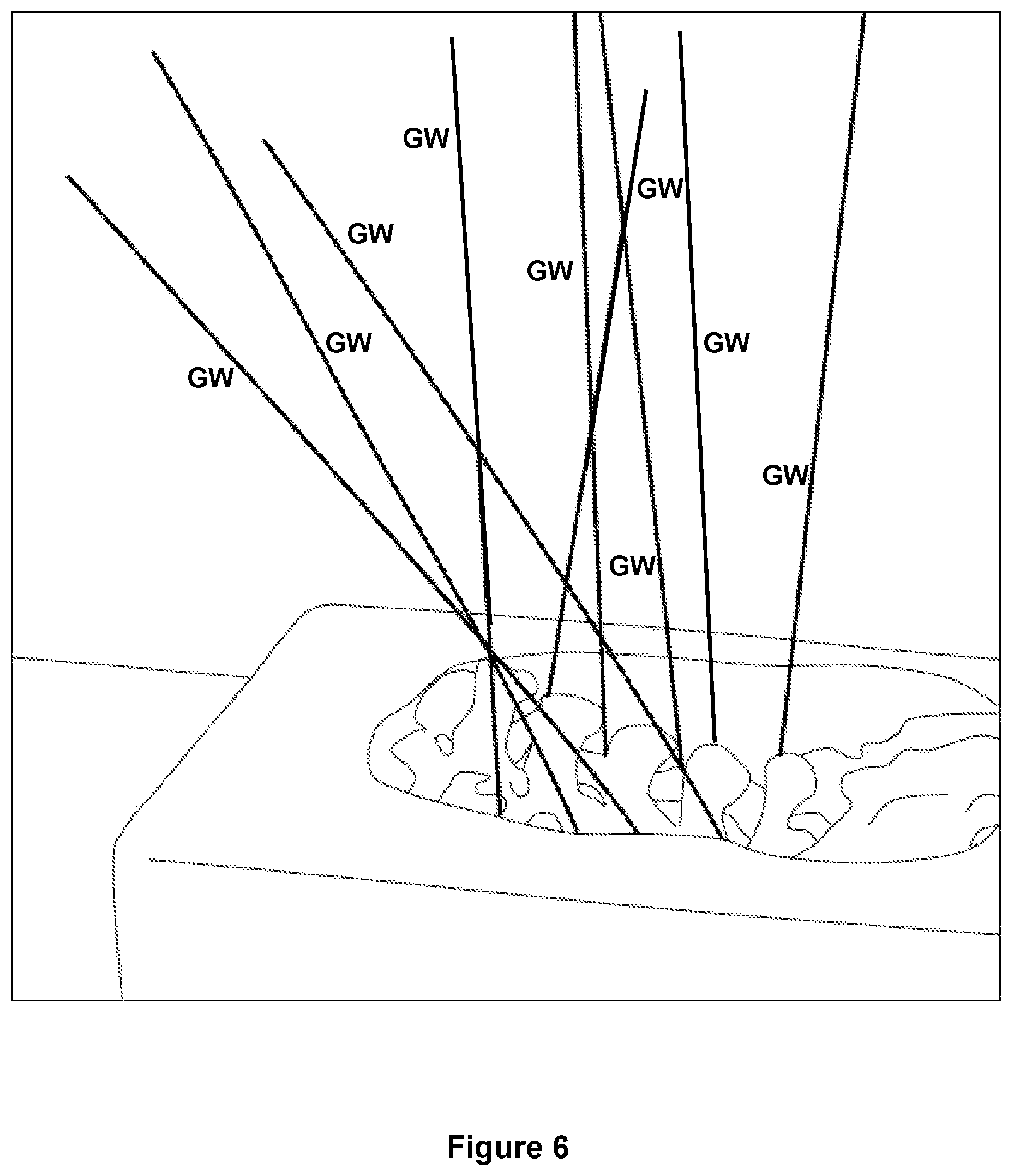 Patent US12588917 Figure 7 – Pedicle marker