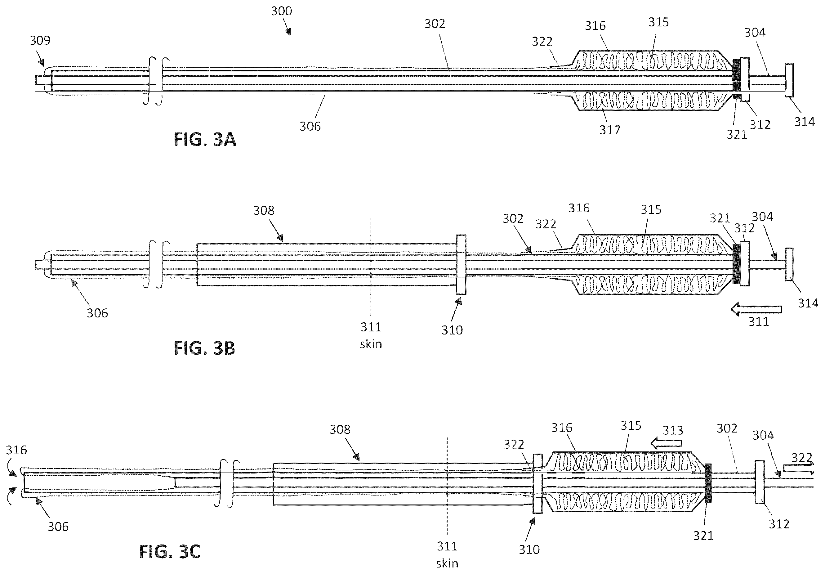 Patent US12588918 Figure 3 – Inverting capture apparatuses having material depots