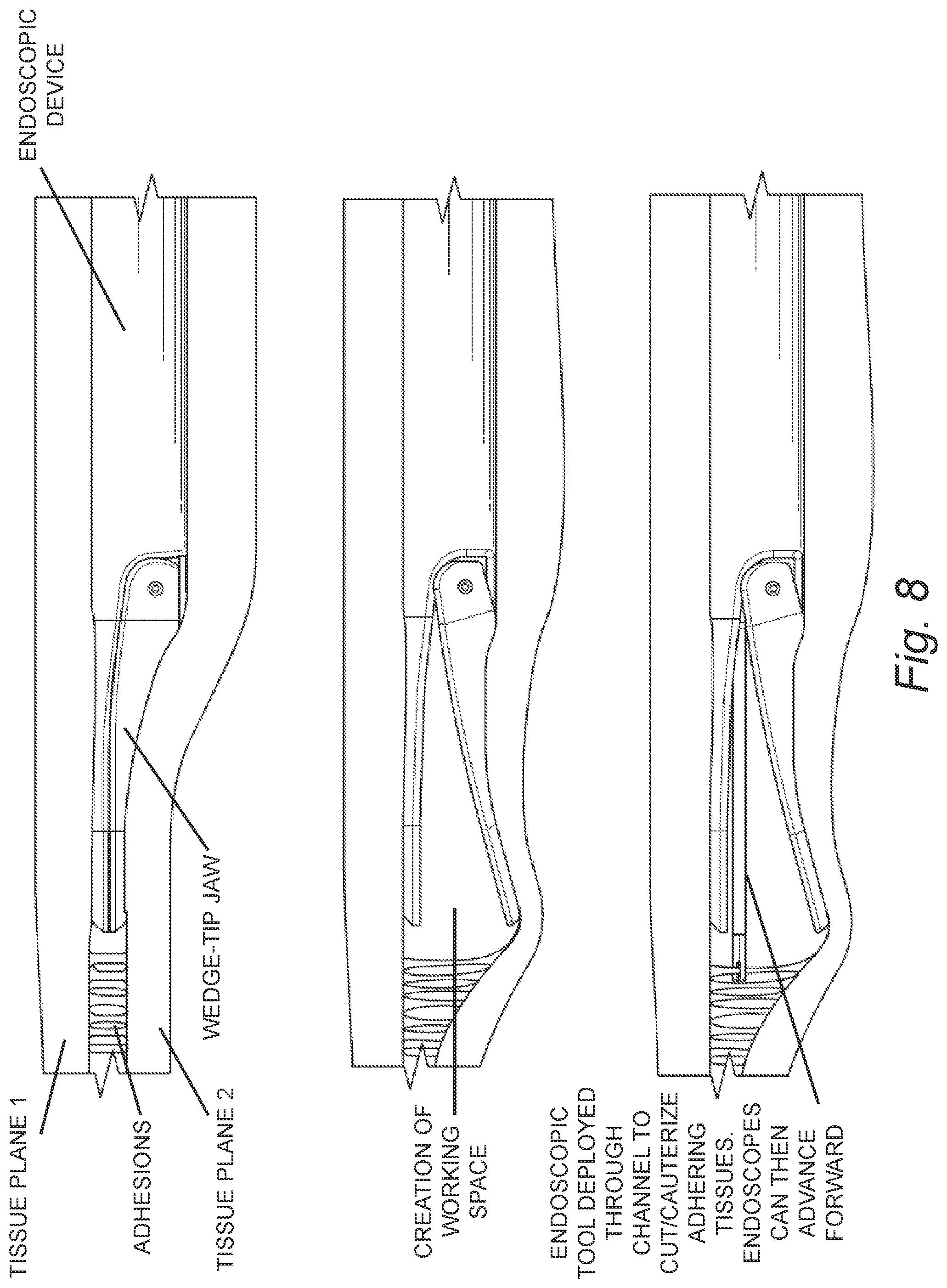 Patent US12588924 Figure 6 – Minimally invasive dissector for inter-layer procedures