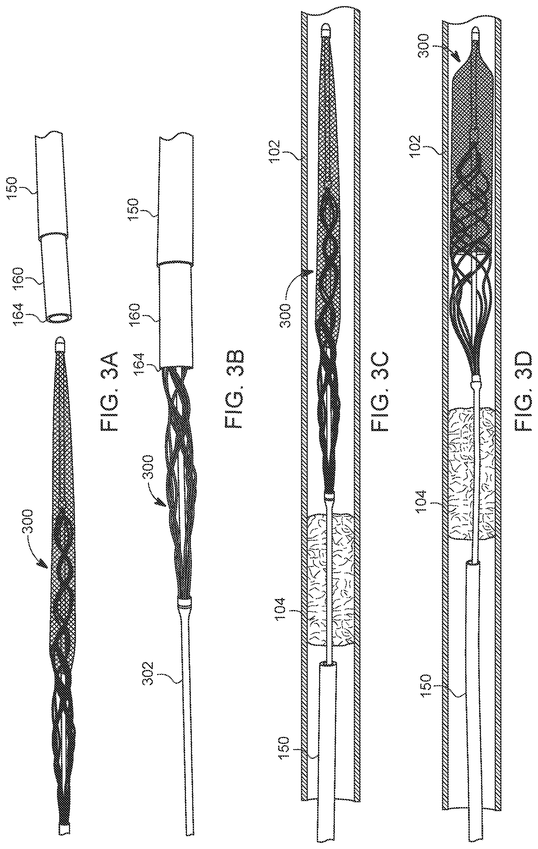 Patent US12588925 Figure 2 – Deep vein thrombosis thrombectomy device with embolic protection