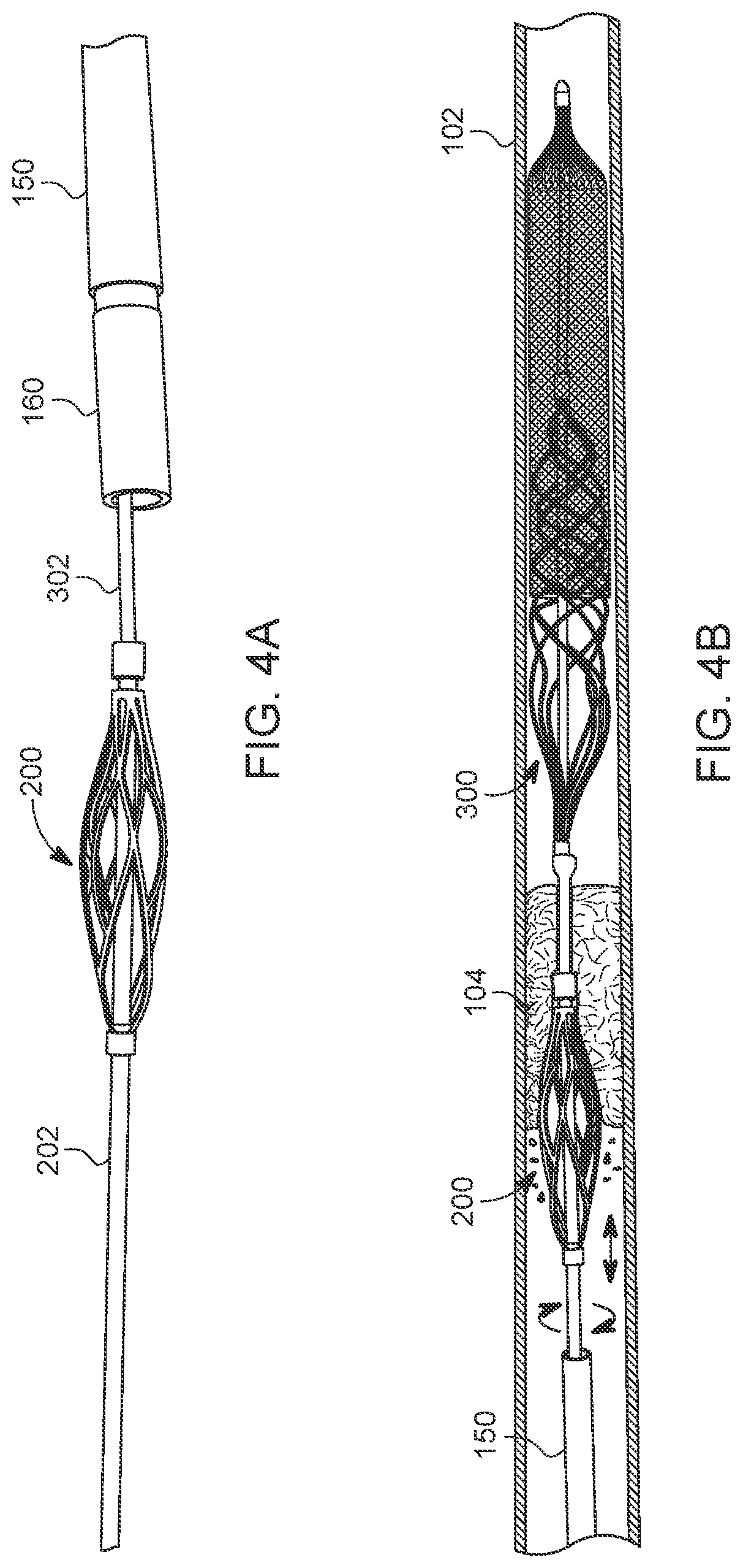 Patent US12588925 Figure 3 – Deep vein thrombosis thrombectomy device with embolic protection