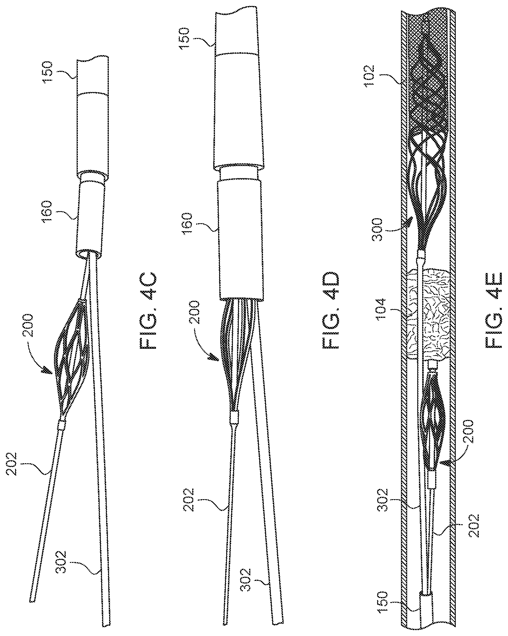 Patent US12588925 Figure 4 – Deep vein thrombosis thrombectomy device with embolic protection
