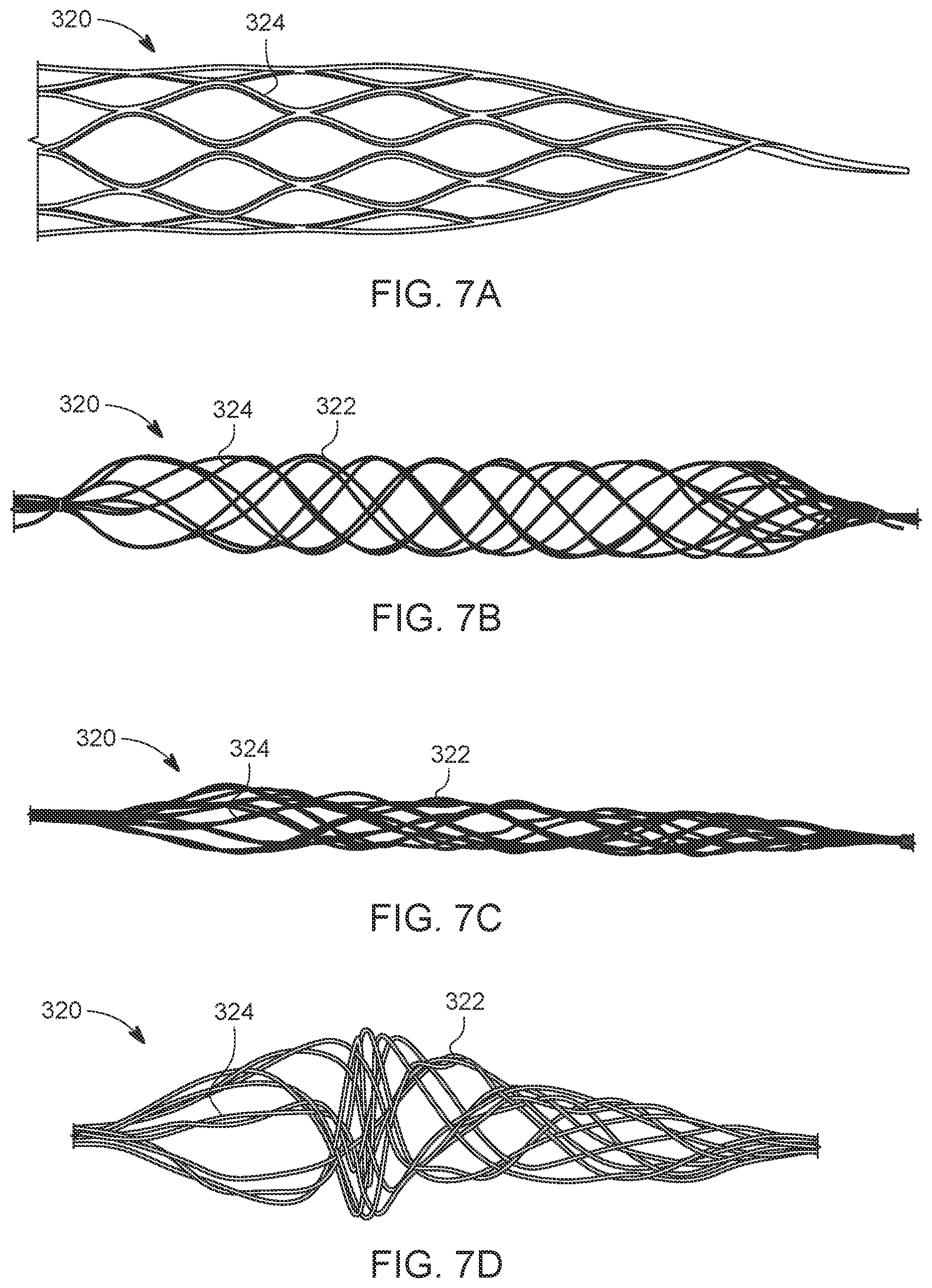 Patent US12588925 Figure 8 – Deep vein thrombosis thrombectomy device with embolic protection