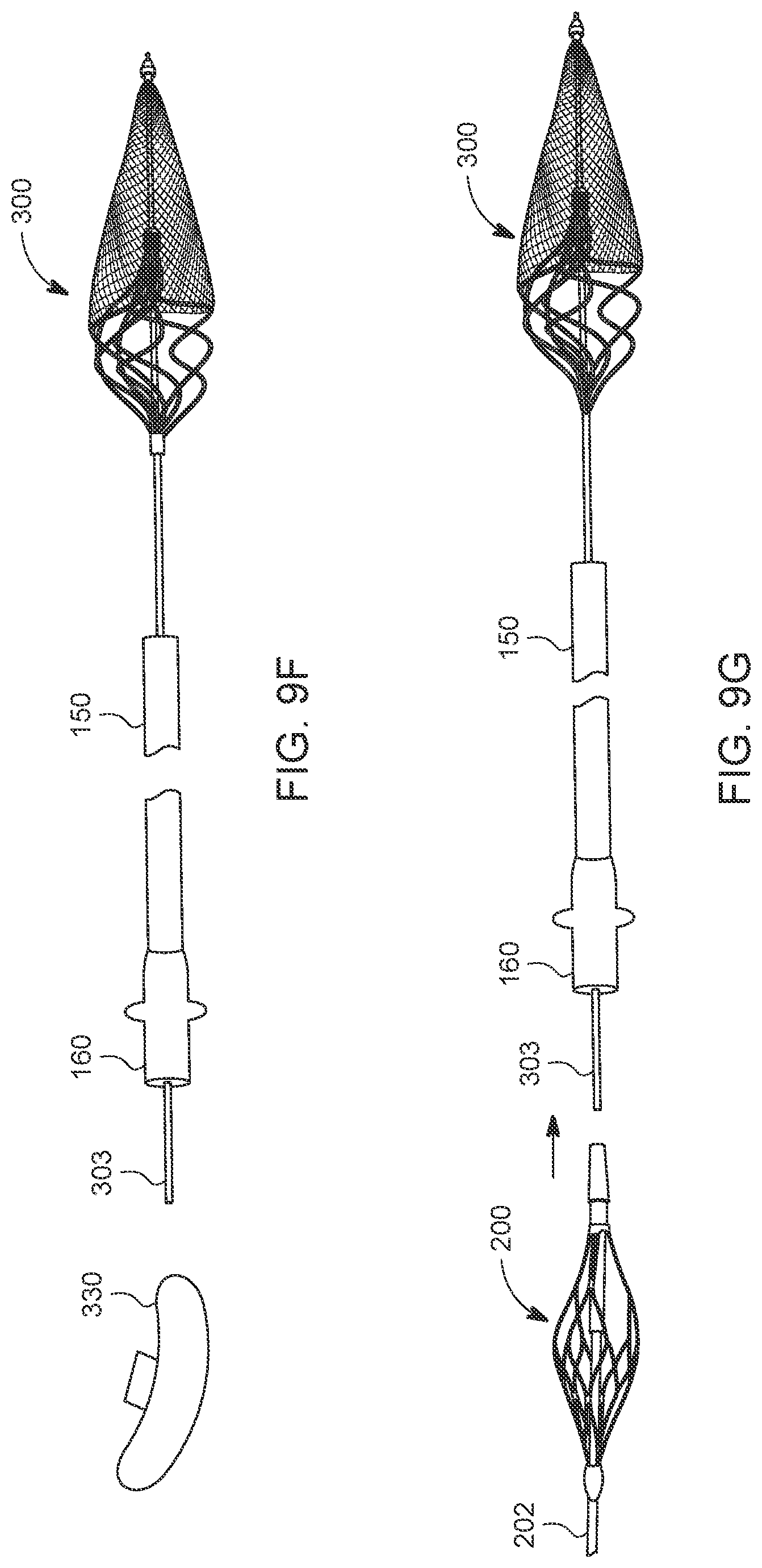 Patent US12588925 Figure 12 – Deep vein thrombosis thrombectomy device with embolic protection