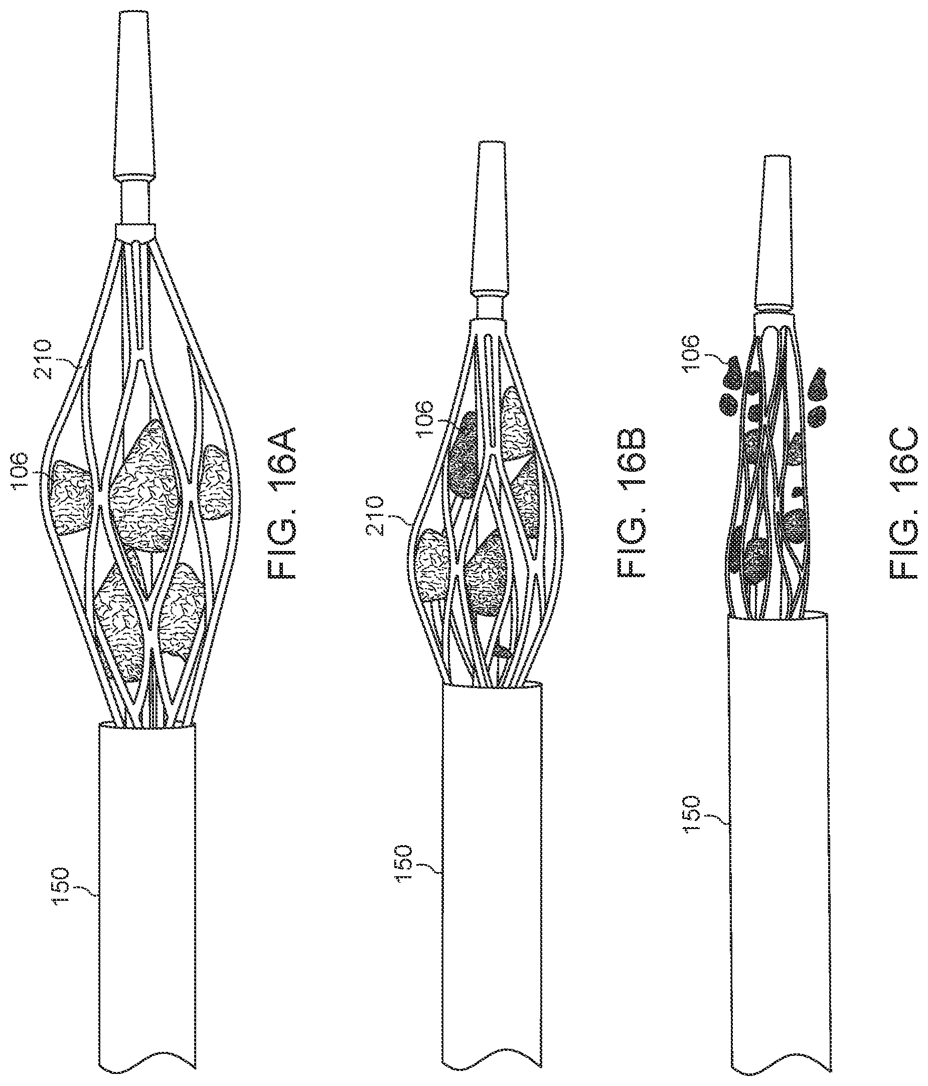 Patent US12588925 Figure 19 – Deep vein thrombosis thrombectomy device with embolic protection